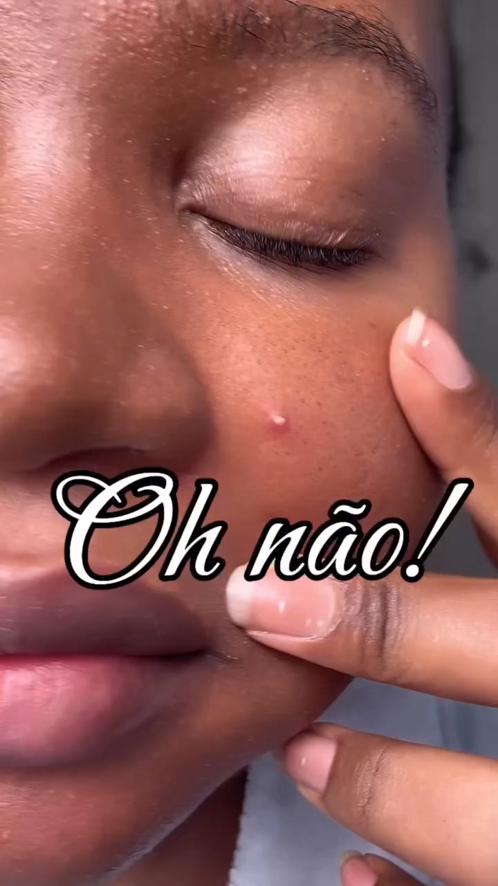 Intruso no meu rosto! 

Eu cuidou da minha pele todos os dias e ainda assim aparecem intrusos indesejados. Já imaginou se eu não cuidasse? Estaria no rosto todo! 

E sei que não é recomendado, estourar mais não consegui evitar 😁😁😁! 

#satisfatorio #satisfaction #skincare #asmr #peleoleosa #acne