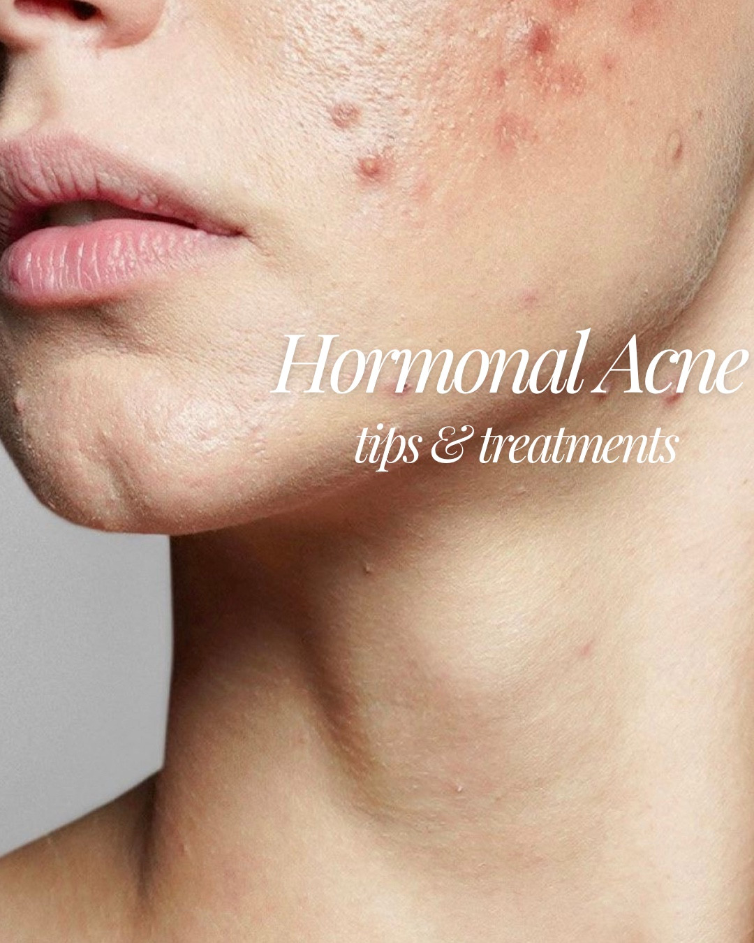 OTC recommendations:
• Salicylic acid (unclogs pores)
• Benzoyl peroxide (kills acne bacteria)
• Adapalene (retinoid for cell turnover)
• Niacinamide (helps regulate oil + calm skin)
• Azeliac acid (helps reduce
hyperpigmentation from healing cysts

#LTKselfcare #LTKgrwm #LTKmorningroutine