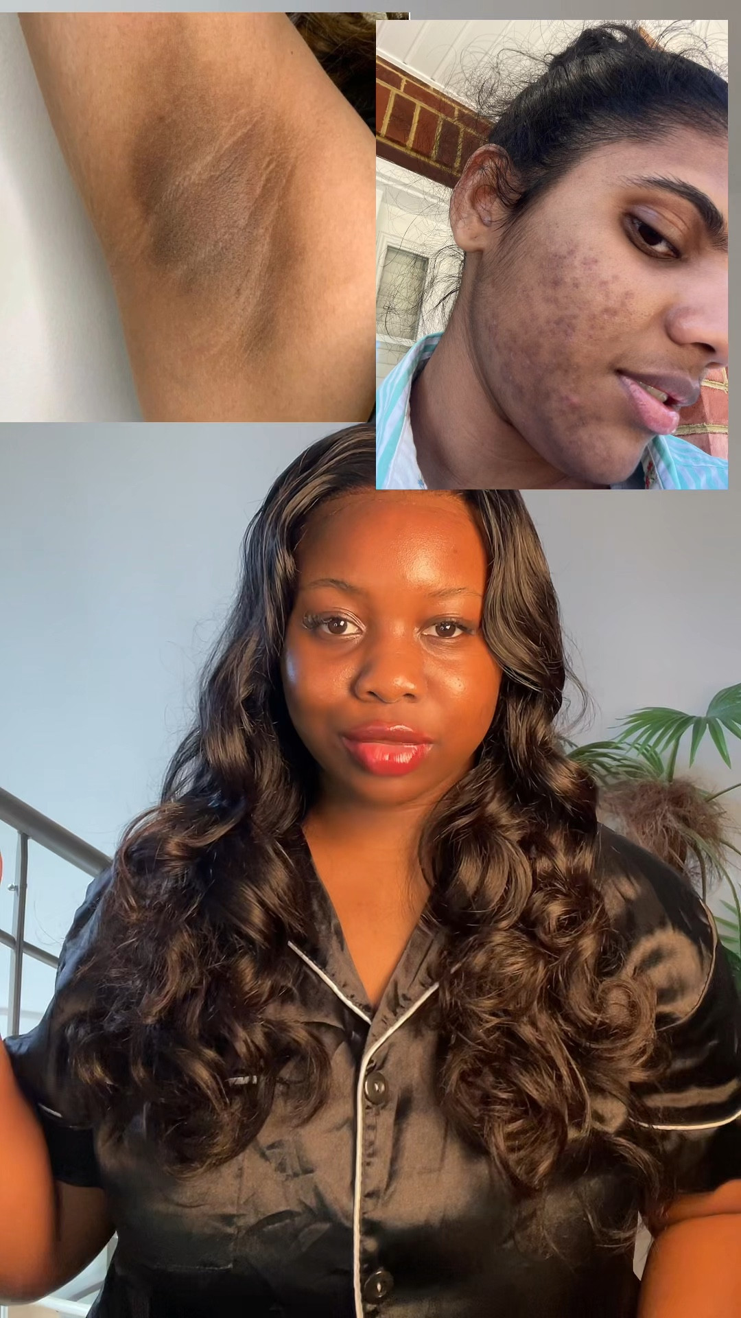 Clearing your hyperpigmentation 