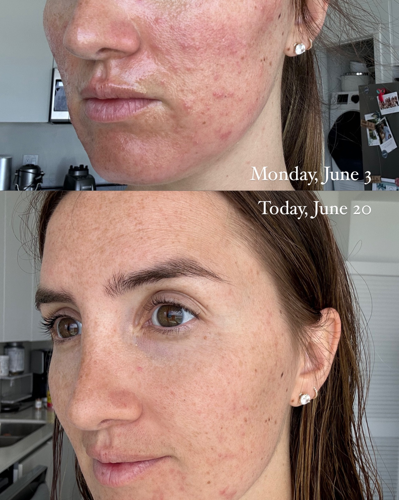 We are still making progress!! I’ve been using the tool once a day, on the blue light setting since June 7! Almost 2 weeks of using this tool consistently and I’m really happy with it! It’s been working for my skin well!

If you’re interested in using the mask, make sure to do your own research and talk to your doctor! 

Use code WELCOME15 for 15% off at Dermstore (works for first time customers!!)

#LTKBeauty #LTKSaleAlert #LTKSummerSales