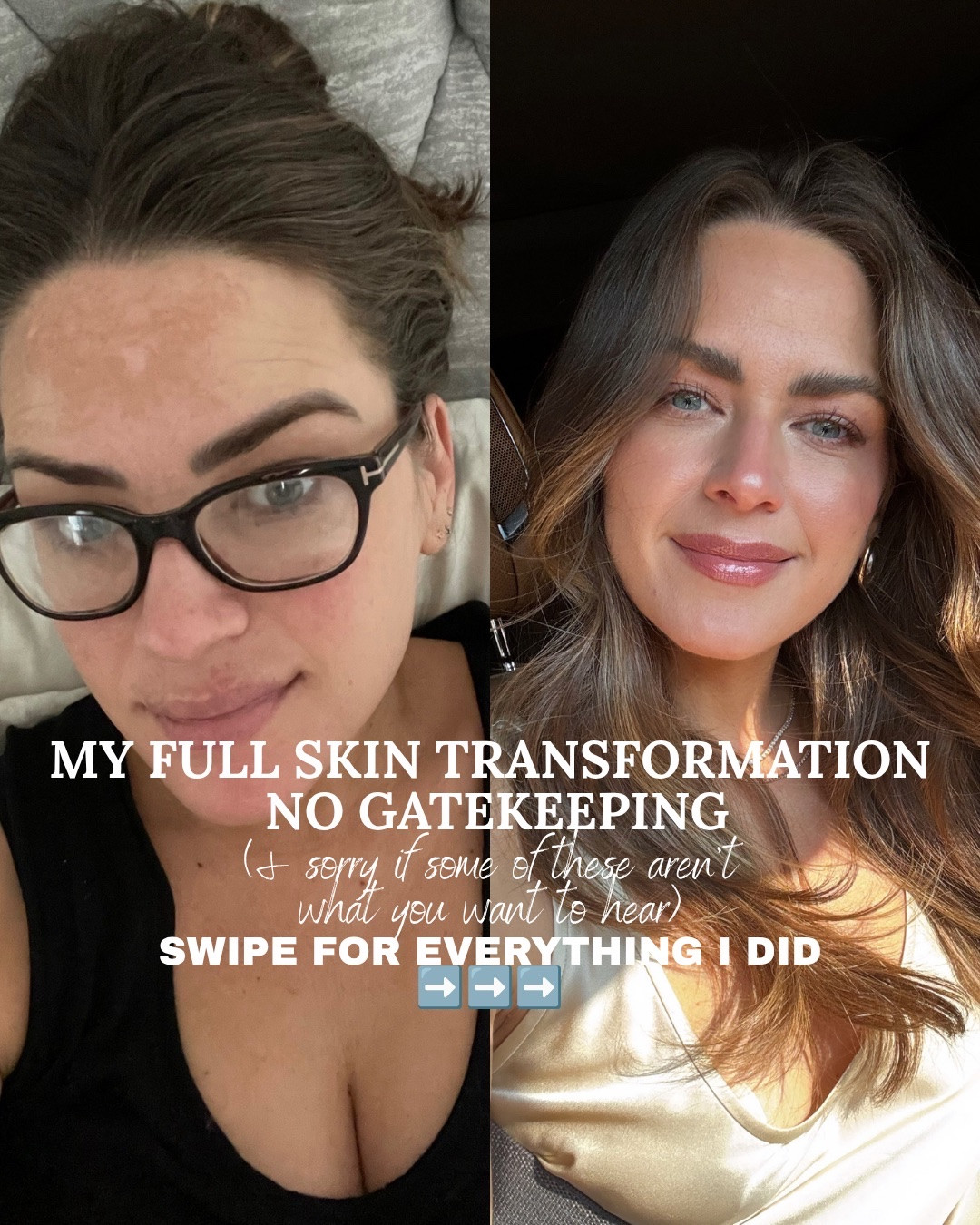 MY SKIN TRANSFORMATION ✨
use code: LAURENROS15 for 15% off Sunday Riley 
use code: LAURENR for 15% off Dermstore
use code: ALOPROFILE for 25% off Seed Synbiotic

#LTKBeauty #LTKgrwm #LTKselfcare
