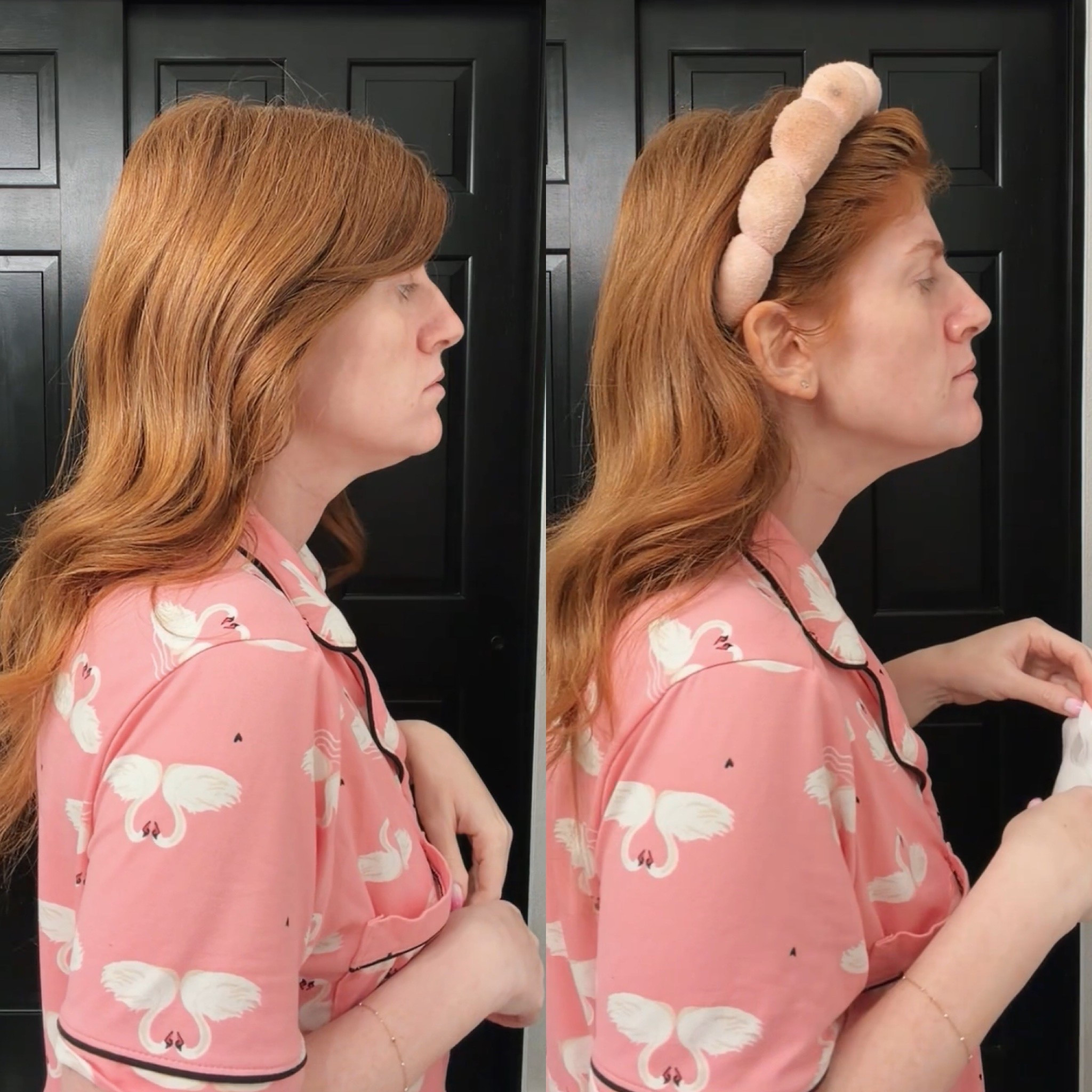 Left before, right after using the chin strap. Actually worked!! 

#LTKmomlife #LTKmorningroutine #LTKselfcare