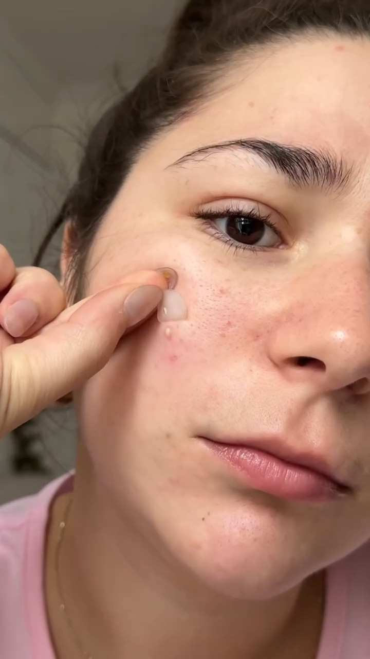 Idk if I like when the patches don’t get all the gunk so I can turn around and pop it or if I’d rather it just pull it all out🥲 what do you prefer? 


#acneproneskin #acnejourney #pimplepatch #pimplepatches #acne

#LTKgrwm #LTKselfcare #LTKmorningroutine