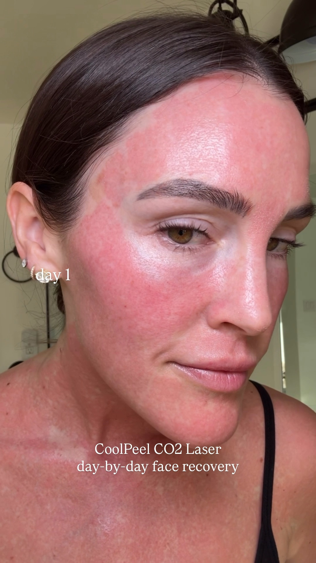 CO2 CoolPeel Laser 🔥 day-by-day face recovery👏🏻 I’m about to be 40 and I wanted to try a resurfacing laser however I wasn’t ready for the BIG one and quite frankly don’t need it. This is why I decided to do the CoolPeel. It rejuvenates the skin by reducing fine lines, sun damage, texture issues, and pore size. It uses laser energy in short pulses that avoid deep thermal damage, stimulating collagen for brighter, smoother, and healthier-looking skin👏🏻 I was told there was minimal downtime BUT in my experience, I was a puff ball and definitely needed to stay home for 4 days - see video🐡😂 The vinegar soaks I started to do really helps with swelling and sloughing. I highly recommend!! Keep the skin hydrated and trust the process👌🏻 Optimal results appear over the following 3–6 months as collagen production increase. Sta tuned for what I think💁🏻‍♀️ For those of you asking about cost, It was $1,300 for the face/neck/chest. A pretty penny. Comment or DM me any other questions.

Beauty
Skincare 

#LTKBeauty #LTKselfcare