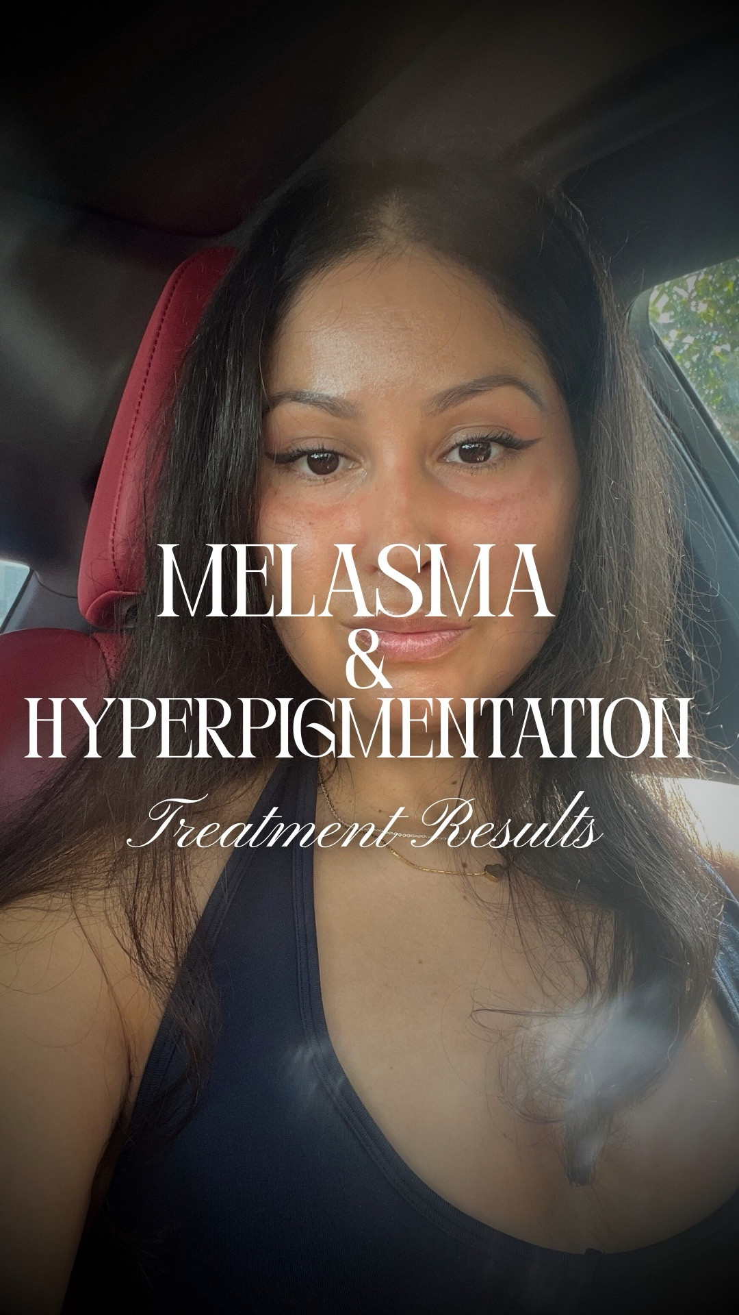 ✨ Real Skin Journey ✨
Dealing with melasma and hyperpigmentation has been a challenge, but consistency is everything! 💫 I’ve been using dermatologist-approved treatments + daily SPF (the most important step!) and I can already see my skin improving.

In this video I’m sharing my progress — from before photos to where my skin is now — and the products that are making a difference. 🌸

If you struggle with dark spots, uneven tone, or sun damage, these skincare must-haves can help support your journey too.

💌 Save this post for skincare inspo
💬 Leave a comment if you’re on your own skin journey
❤️ Like, share & follow for more beauty tips and product finds!

#MelasmaTreatment #Hyperpigmentation #DarkSpotCorrector #SPFAlways #SkincareThatWorks #SkincareRoutine #GlowingSkinJourney #BeautyOnLTK

#LTKBeauty #LTKActive