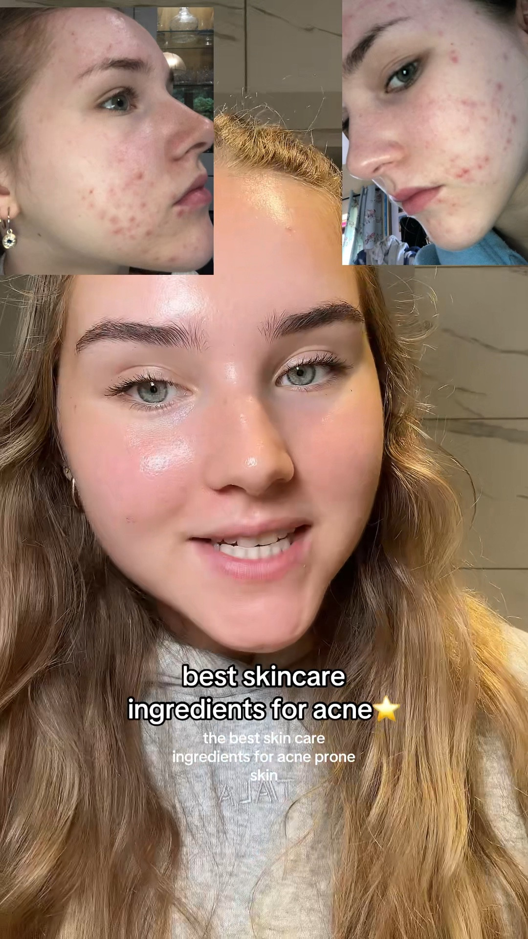 Best skincare ingredients for acne !