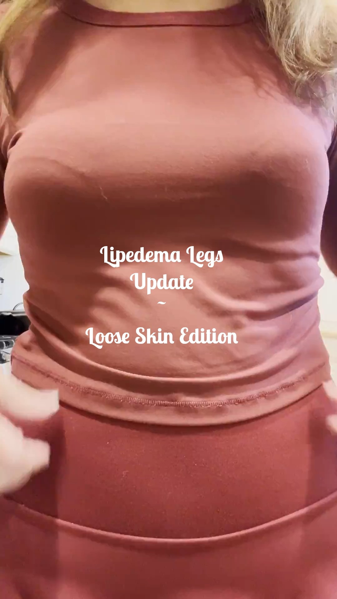 Recent update🦵
The legs are showing out
The movement is astounding and not very comfortable with all this loose skin and hanging Lipedema.

This year will have a retraction focus, too so stay tuned 🙏
#lipedemaweightloss #weightlosscommunity

#LTKMidsize #LTKActive #LTKOver40