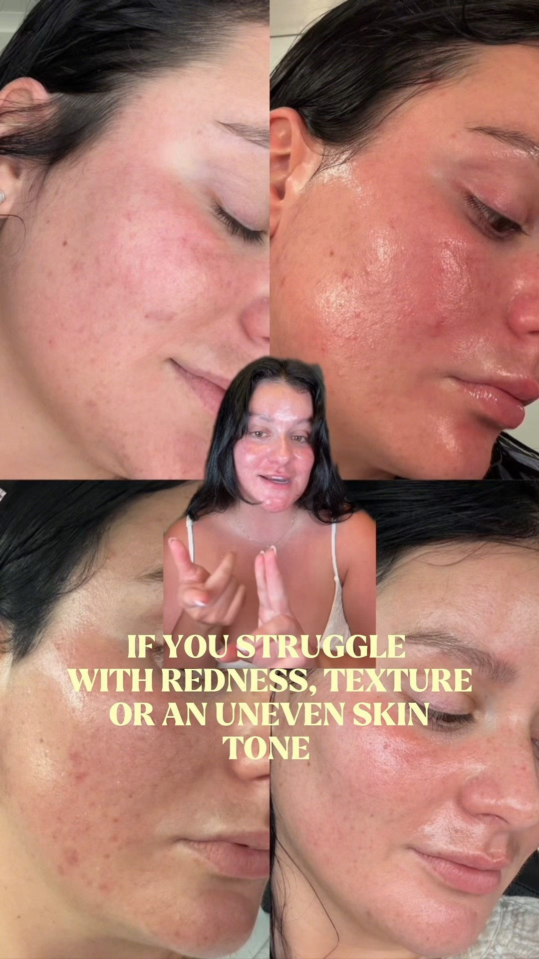 the best azelaic acid for beginners 🩵