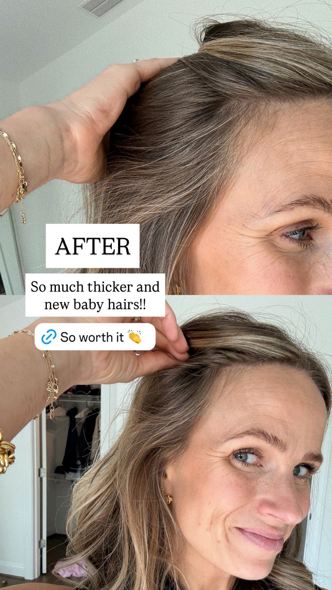 After OneSkin’s hair serum- So much thicker and new baby hairs!!

#LTKBeauty