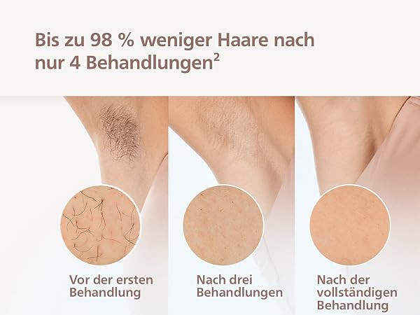 Philips Lumea IPL 9000 Series - IPL Ger\u00e4te Haarentfernung f\u00fcr bis zu 2 Jahre seidig-gla... | Amazon (DE)