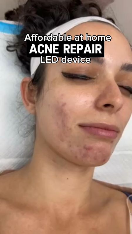Blue light therapy was one of the things I used to help treat my acne and have clearer skin. I use the revive sonique cleanser that provides red + blue light therapy but there are options for just acne or just wrinkles and some super affordable options. 

Skincare routine acne routine travel must haves 

#LTKtravel #LTKbeauty #LTKfindsunder100