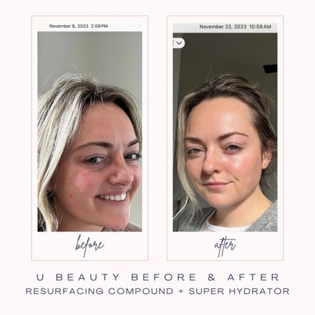 The before and afters of this U Beauty DUO is pretty insane! 🤯 I notified a difference in my skin in probably just 3 days. After two weeks of using morning and night, I felt like I had new skin. Brighter, more even, reduced pore size, and SO MUCH GLOW! It’s pricey, but it’s 💯 worth it! 

#LTKbeauty #LTKSeasonal #LTKover40