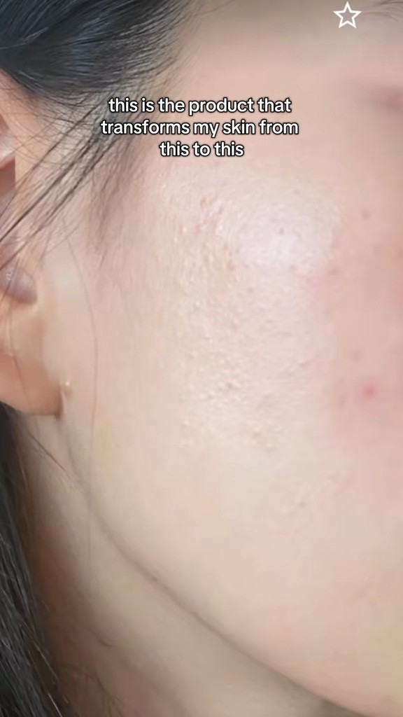 a lot of people can’t tolerate this product but for those who can, it’s such a great product for texture and whiteheads! I wouldn’t recommend this to sensitive skin tho and always start with lowest dosage and build up your tolerance ! 

#LTKselfcare #LTKBeauty