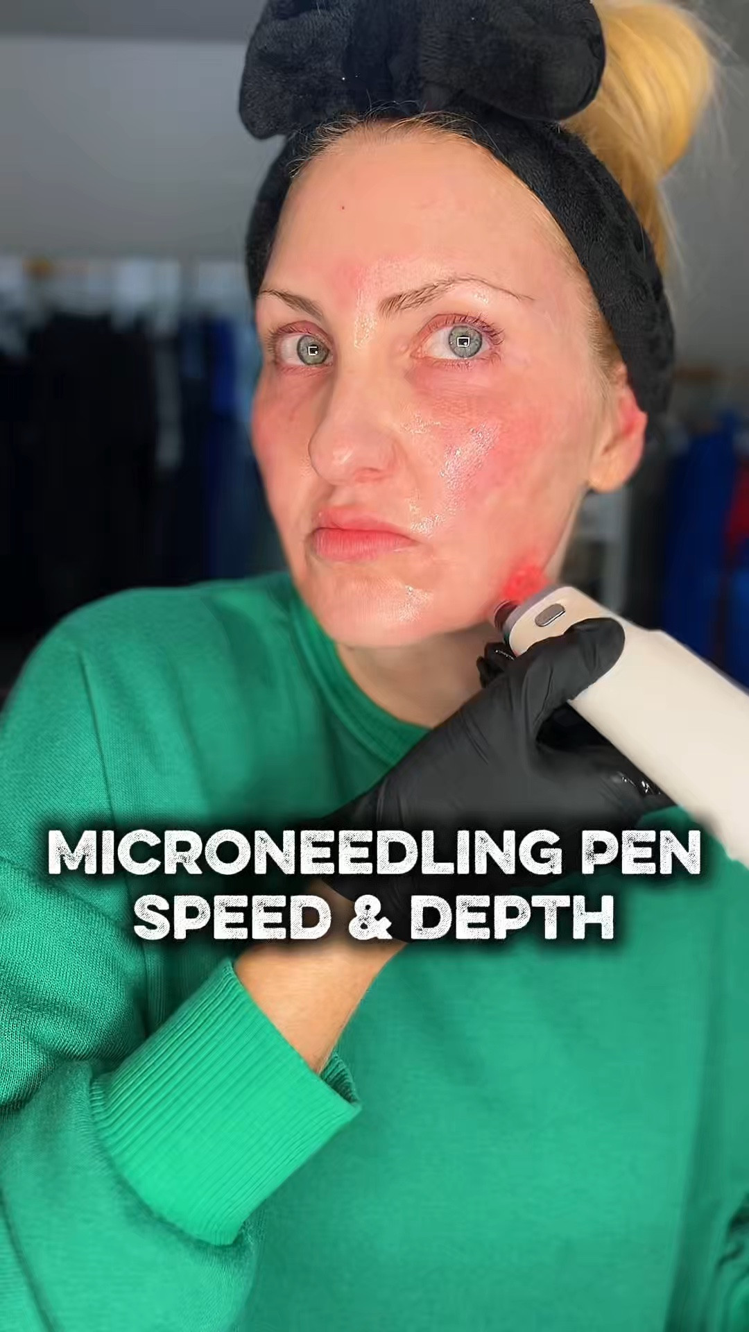 💉Microneedling pen speed and depth matter!! Deeper or faster doesn’t always mean more effective or better. 💕
Learn how to do your own treatments at home for a fraction of the price at a med spa. 
✨Follow for more!!

#LTKdayinmylife #LTKselfcare #LTKBeauty