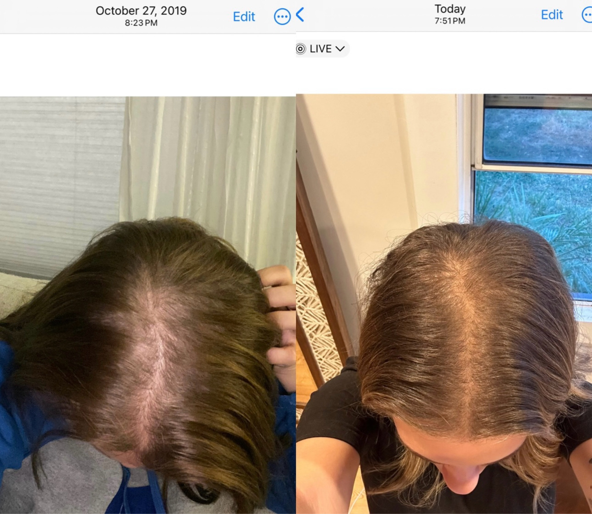 My hair growth journey

#LTKStyleTip #LTKBeauty #LTKGiftGuide