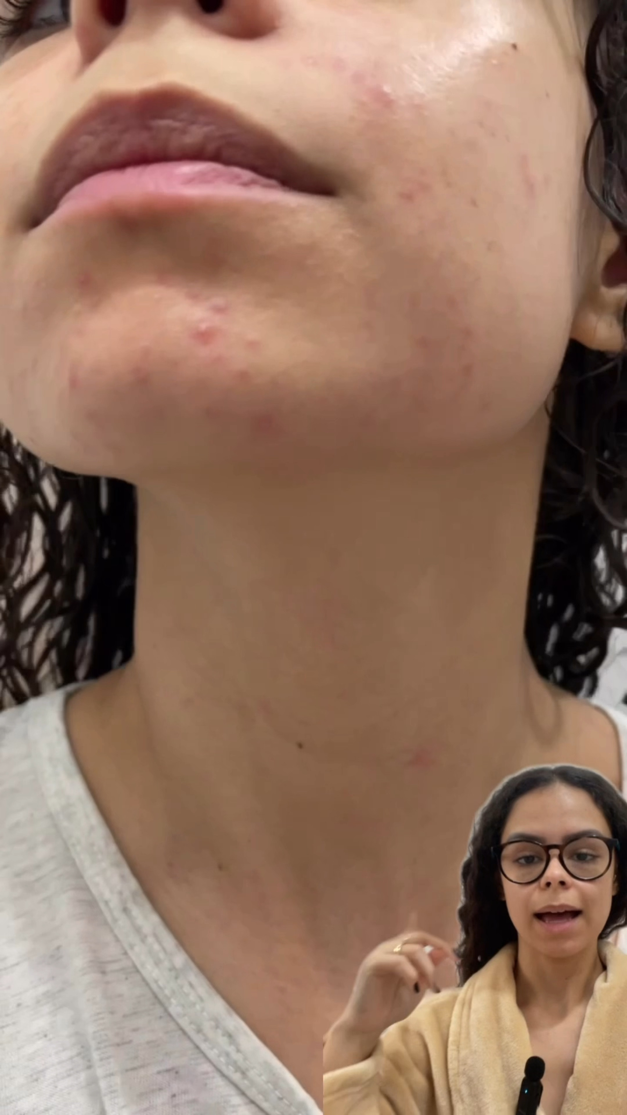  Se puder, consulte um dermatologista antes de iniciar seu tratamento ✨

Minha pele é oleosa então eu uso a versão em gel, a versão em creme é usada para tratamento de rosácea!

Se tiver alguma dúvida sobre o produto, deixa aqui nos comentários ❤️

#azelan #acidoazelaico #acne #tratamentoacne #acnemulheradulta #tratamentoacnemulheradulta #espinha #acido #ácidoazelaico

#LTKbeauty #LTKbrasil #LTKVideo