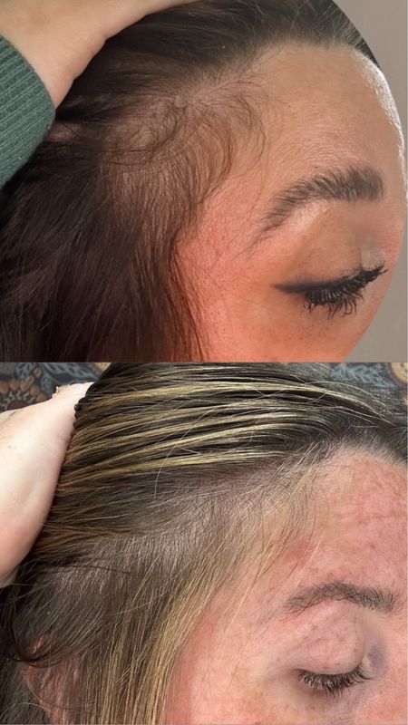 My 3 month results of using Divi! @divi 

I know it’s slightly harder to see because I have blonde highlights now but you can still see a huge difference in the fullness on my scalp! Not saying I had “bald spots” before but definitely scalp is much fuller! My hair also feels thicker! 

#LTKBeauty