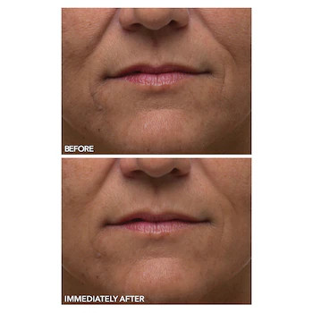 Dr. Dennis Gross SkincareAlpha Beta® Ultra Gentle Daily Peel for Sensitive Skin | Sephora (US)