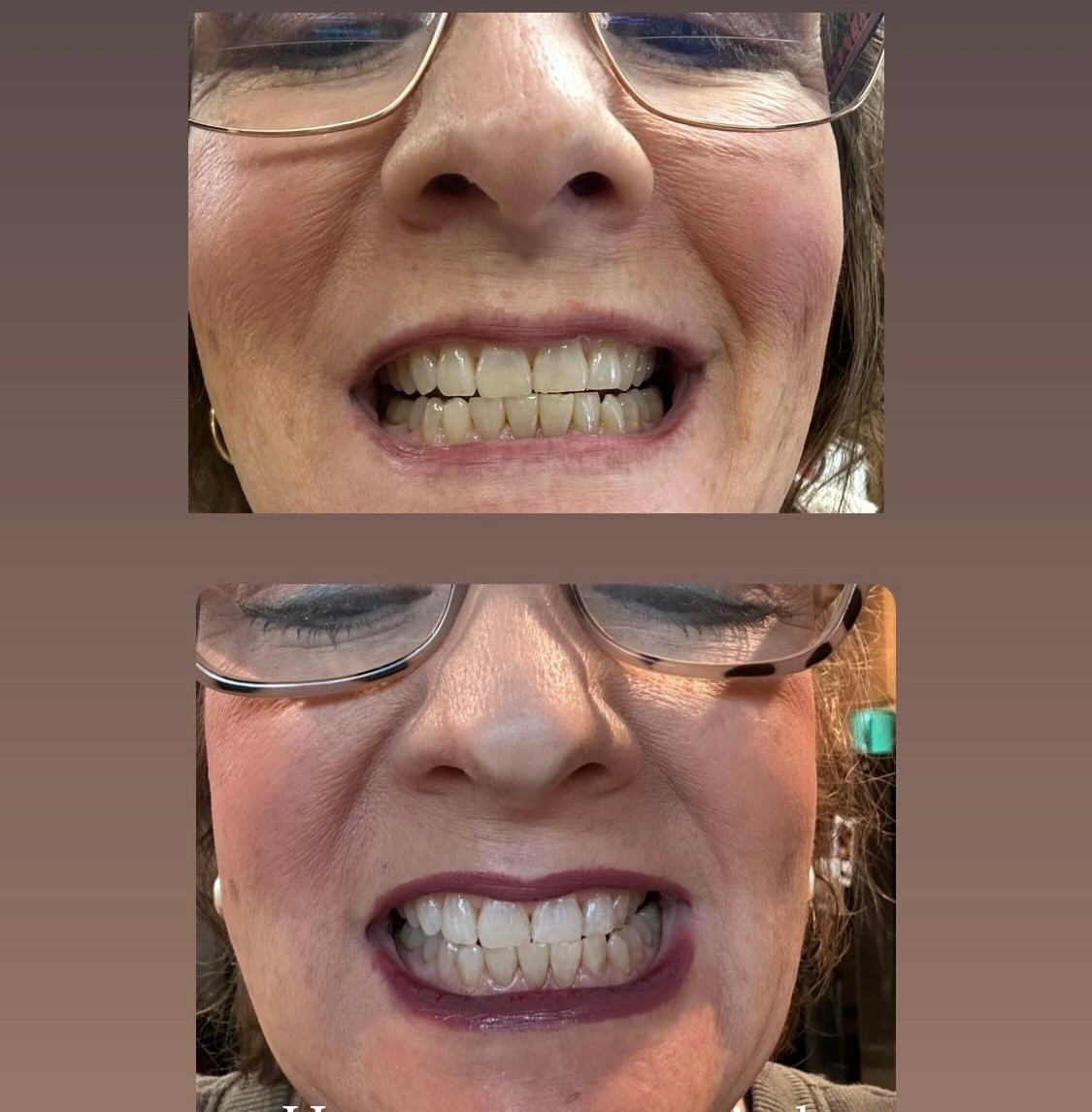 I wanted to find out if this works as well as the "influencers" say it does. Here are my #Lumineux results after only 5 days. I'm a believer now! Absolutely no teeth sensitivity. #teethwhitening #whiteningstrips #lumineux  
(I am not working with lumineux- wish I was) 😊

#LTKFamily