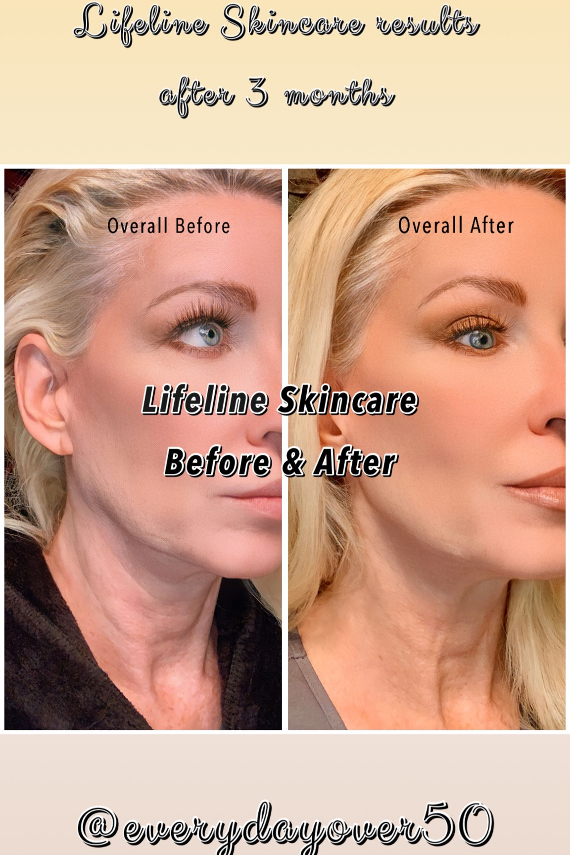 Use code DENISE50 for 50% off your purchase!🛍️
I’m so excited to share my results from using the @lifelineskincare product line over the past 3 months! I’m truly blown away with the results in my photos! (Watch till the end of the reel!)All these products were developed using a microscopic encapsulation of stem cell proteins. And they work! Let my before and after photos speak volumes🙌🏻🌟 #lifelineskincare #mylifeline #ad

Lifeline is so confident you'll love their products, they offer a 30 day money back guarantee! You can learn more about their revolutionary technology at lifelineskincare.com or on IG @lifelineskincare ❣️

Use code DENISE50 after for 50% off your purchase! 

#LTKunder100 #LTKbeauty #LTKFind