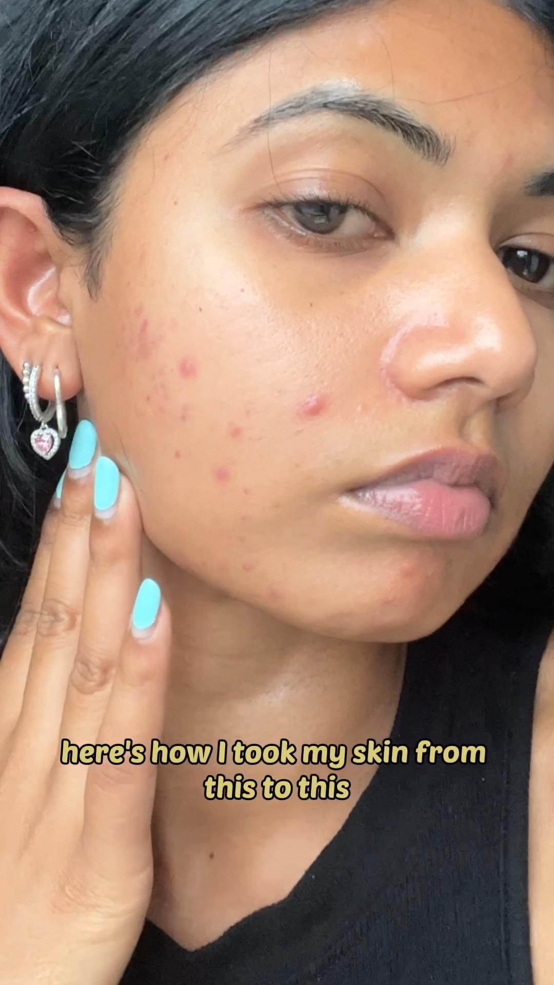 The 4 products that changed my skin in just 3 weeks:
Youth to the people superfood cleansed 
The Ordinary niacinamide & zinc  
First aid beauty coconut water cream gel 
La Roche Posay 50+ spf sunscreen 

#LTKeurope #LTKSeasonal #LTKbeauty