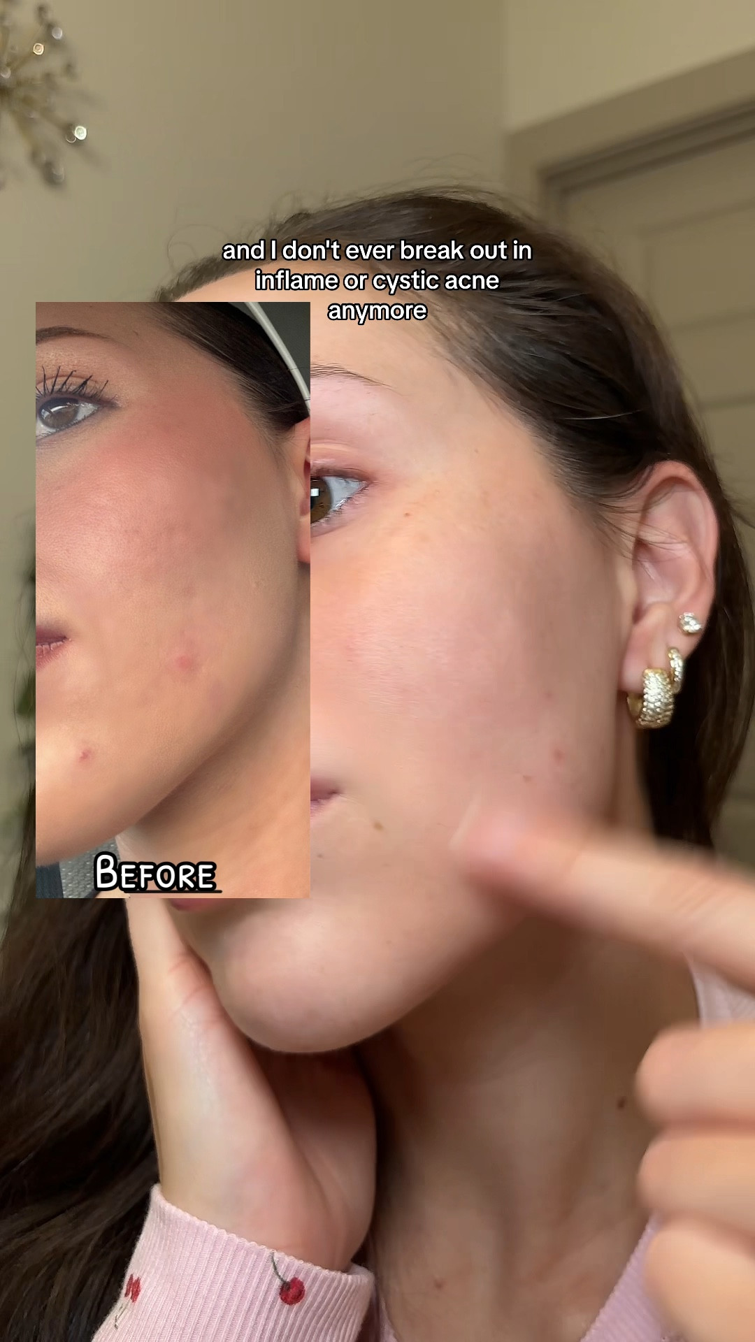 Red and Blue light Therapy mask for clearer skin

#LTKBeauty