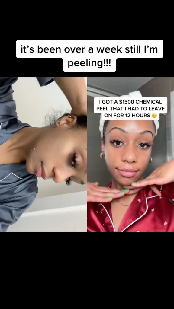#duet  with @Tiara Willis  #chemicalpeel  my skin got dark again and is flaking/peeling another time! I took a break from aftercare for a few days to stop the peeling for an event but now I started up again and am back to peeling 

 