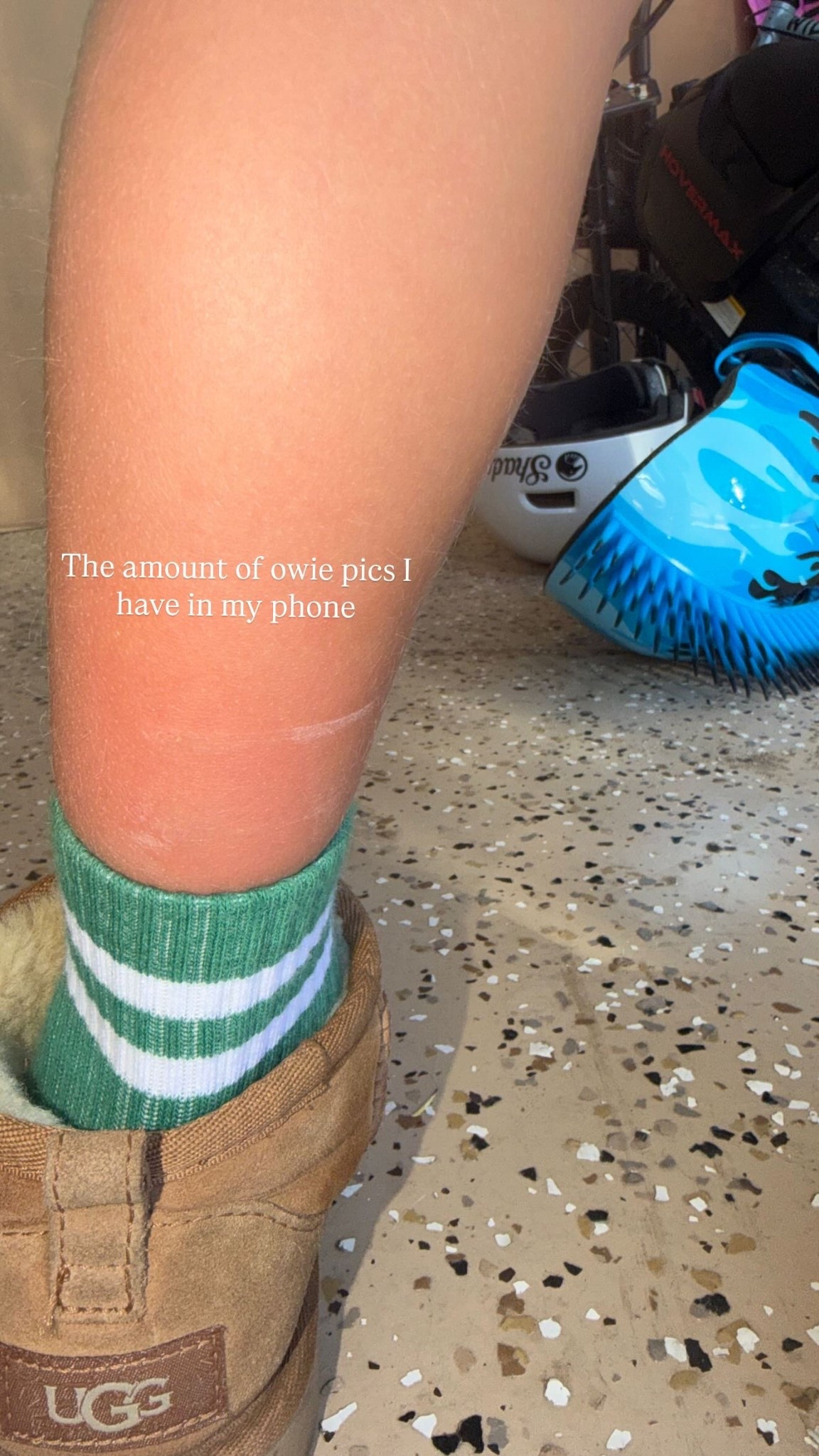 The amount of owie pics I have in my phone