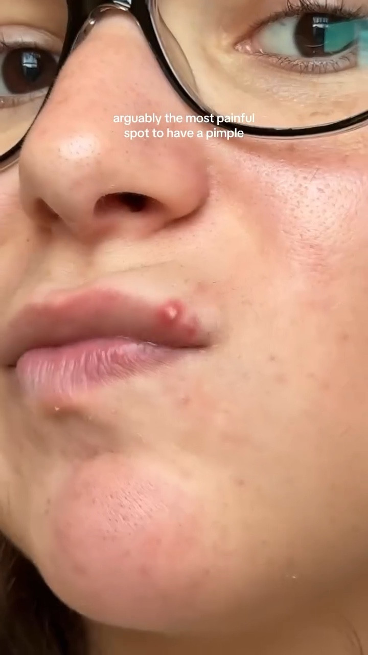 I still think about this pimple

#acneproneskin #acnejourney #pimplepatch #pimplepatches #acneskincare