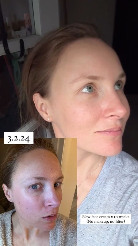 Miracle face cream! 10 weeks in and my skin has completely changed.

A few things to note: this is a retinol cream. I was hesitant to start it and I’m so glad I did. 

You will experience redness, itching throughout and skin sensitivity especially in the first few weeks of using the product. Retinol/vitamin A absorbs through your skin and into your bloodstream so you may experience skin sensitivity in other areas of your body. For example, one night behind my knees itches! 

Start slow alternating days as your face builds up a tolerance. My aesthetition recommended that I start on ,25 every other day. Now I am at 1% daily. I didn’t really start to see change until I switched to 1% but I’m glad I started on a lower does.

Moisturize! Your skin will be sensitive and dry at first. My drugstore ponds was perfect for this and I know helped reduced peeling and overall redness. Your skin is also more sensitive to sun so find a good daily sunscreen - linking my favorite below. 

Exfoliate with a soft cloth and gentle face cleanser regularly. Retinol helps speed up the skins renewal process leaving you with fresh skin, reduced fine lines and increased smoothness but you do have to help remove the peeling. 

I experienced more redness than extreme peeling. I had a few days where I couldn’t wear makeup due to the peeling. Some people experience both or the opposite. I will say you have to commit - don’t quit! Keep going for at least 8-10 weeks. . 

I am not a medical doctor, dermatologist or aesthetician. Consult a professional for questions - this is just my personal experience. Do not use if you are pregnant or nursing or trying to become pregnant. #skinxare #beautyroutine

#LTKBeauty