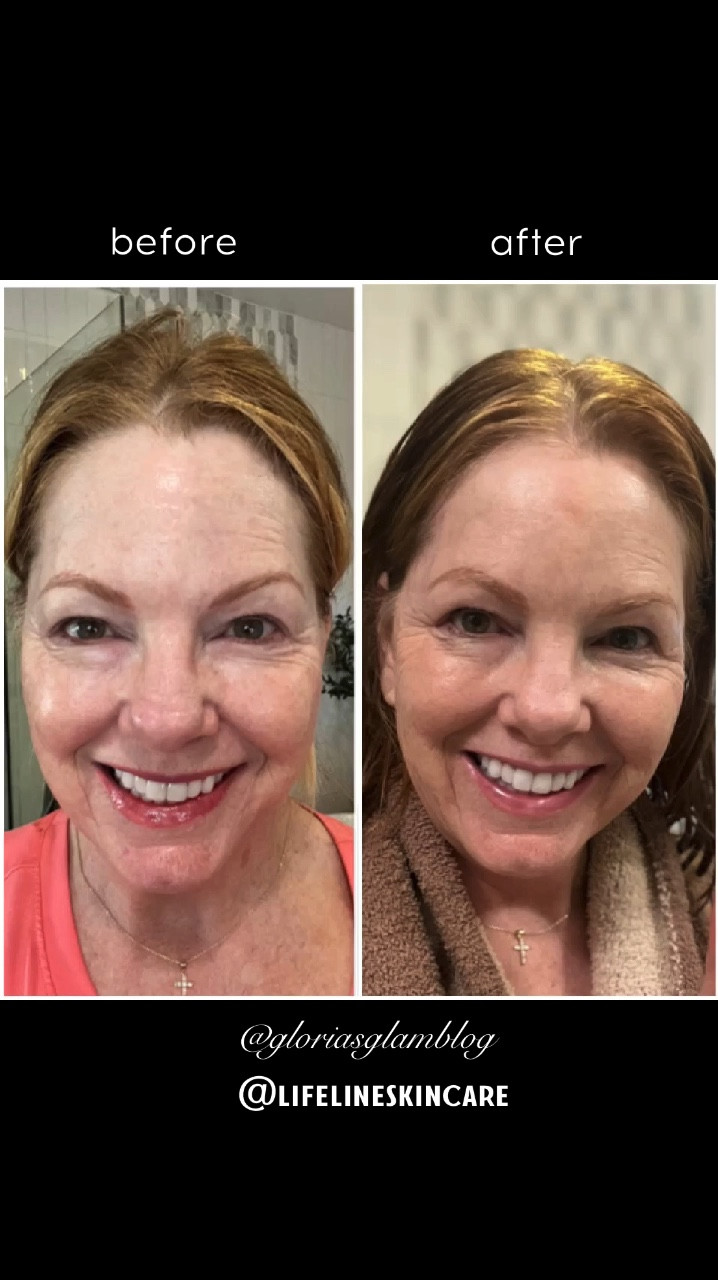 I took the 30 day Eye Firming Challenge with LifeLine ProPlus Eye Firming Complex. I see such a difference in my fine lines and wrinkles! Here’s why it’s different and why it works.

➡️ The key ingredients and benefits ⬅️

• Non- embryonic human stem cell extracts stimulate fibroblast activity
• Support elastin and collagen production
• Support hyaluronic acid production
•Help accelerate cellular renewal
• Stabilized Vitamin C Helps reduce UV- induced skin damage 
• Matrixyl 3000 Reduces the appearance of fine lines and wrinkles 
• Hyaluronic Acid helps increase moisture content in the skin • Encapsulated Caffeine reduces the appearance of dark circles and puffiness • Dynalift Ingredient of vegetable origin provides an instant tightening effect on the skin 
• Helps wrinkles decrease by 23% within the first hour of usage 

It has cumulative benefits on the skin, however the goal with this ingredient is to have that instant tightening.

Try it and see for yourself!

@lifelineskincare #lifelineskincare #stemcellskincare #eyefirmingcomplex #beforeandafter #antiagingskincare

#LTKOver40 #LTKBeauty