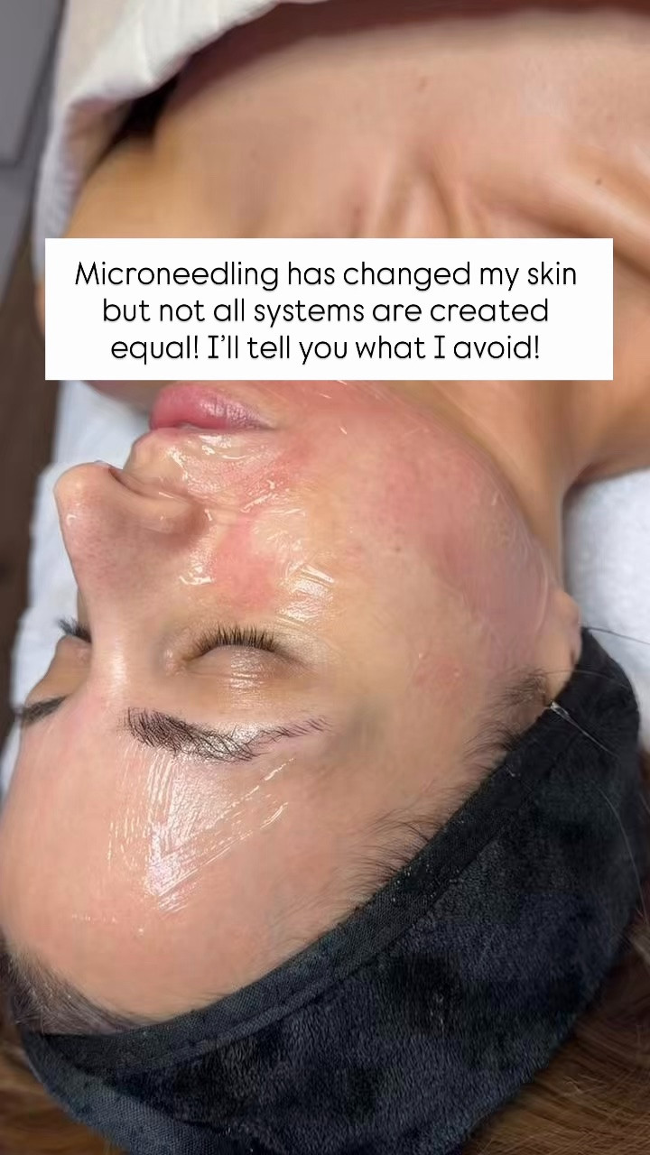 I’ve tried SO many different systems but I personally love SkinPen! SkinPen is a type of microneedling. I would find someone in your area who does that. You typically need 4-6 sessions to get the results you’re after and can usually purchase a series of 3 to save a little $$ overall. You space them out a month or so in-between treatments. After you’re done with that initial 4-6 treatments - you can usually move to maintenance (maybe for you that’s twice a year - everyone is different). SkinPen is actually more budget friendly than other systems too. Microneedling RF is all the rage but I would personally stay away from it because it can inadvertently target fat in your face and I don’t have a lot of fat to begin with so I don’t want them to accidentally blast that. You are red for 24-48 hours and can wear makeup after 48 hours so recovery isn’t bad at all! They usually numb you so the pain isn’t too bad but I would ask your provider if they do this!

#LTKmorningroutine #LTKselfcare #LTKBeauty