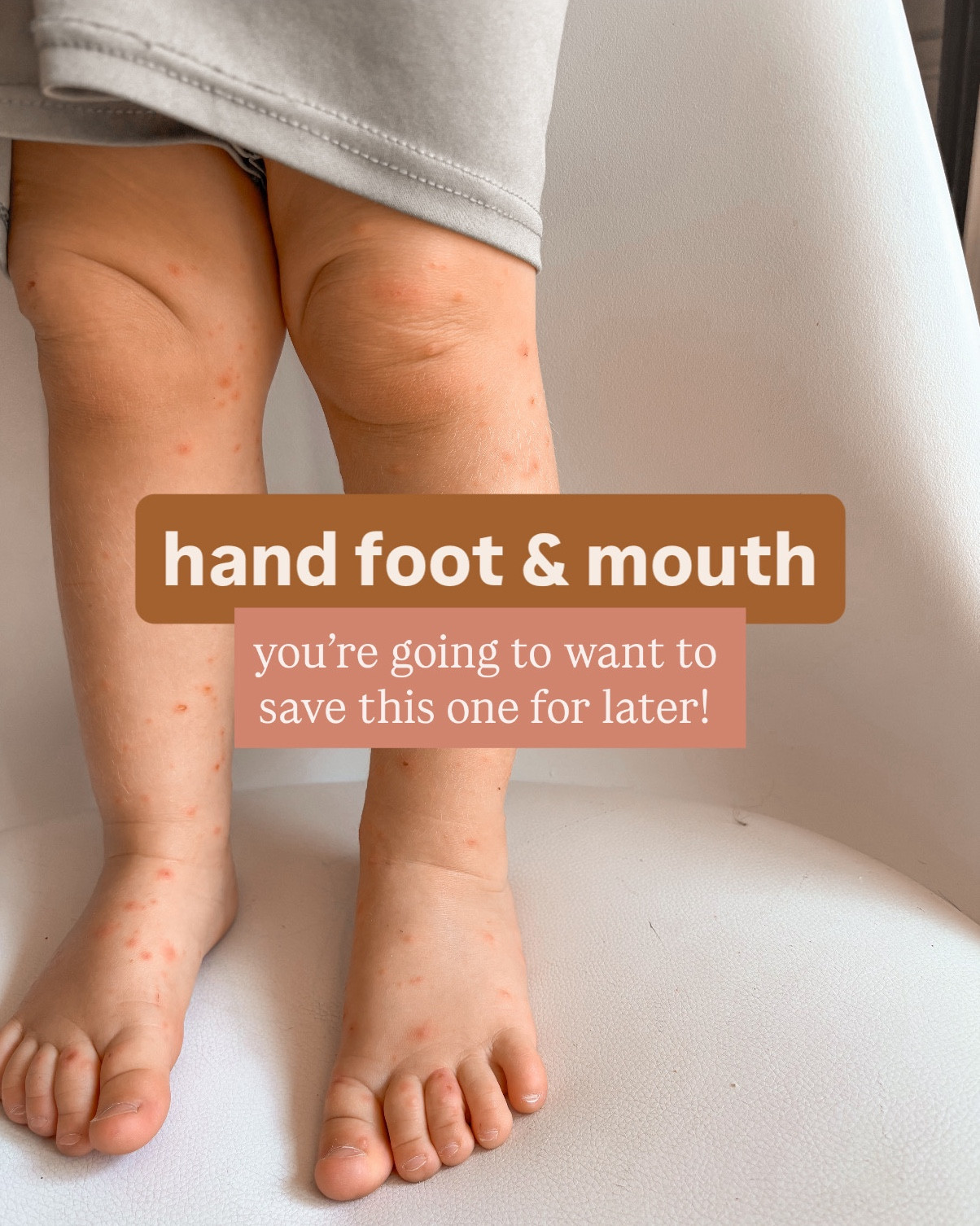 not medical advice, just what has kept the kids comfortable during HFM!

#LTKBaby #LTKKids #LTKmomlife