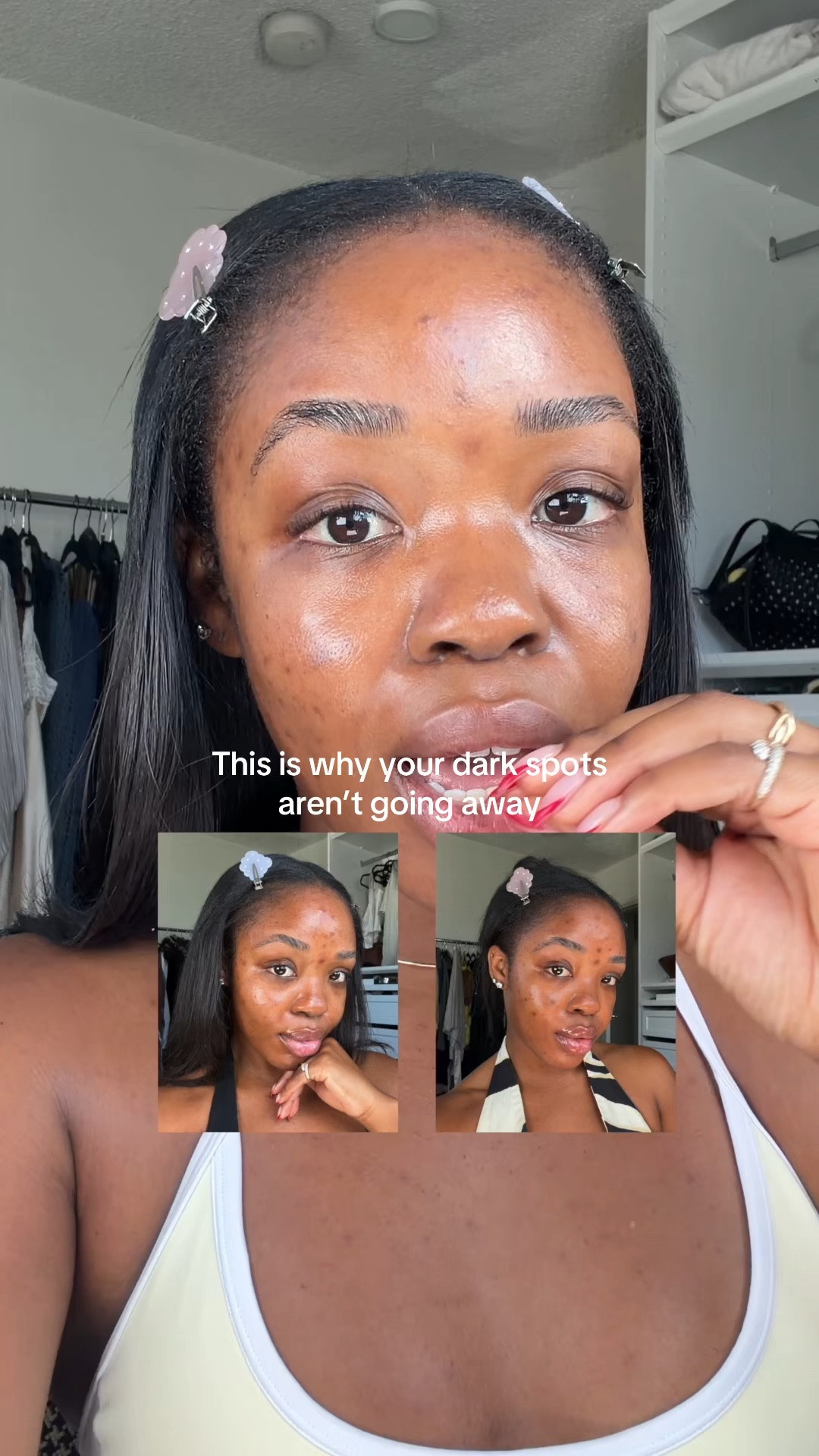 you could be forgetting to do this👀 I reapply my sunscreen at least 3-4x a day now, I’m real serious about getting rid of these dark spots✌🏾#spf #sunscreen #hyperpigmentation #darkspots #skincaretips

#LTKBeauty