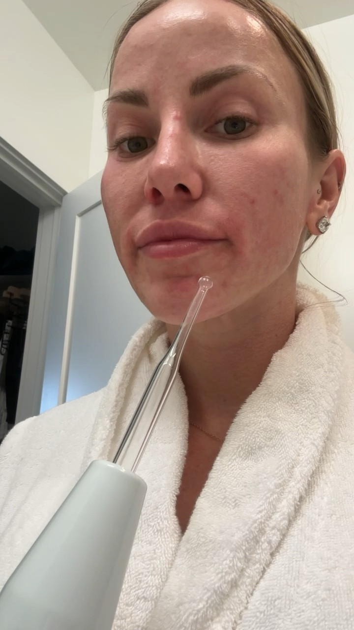 Literally can hear my zit dying. #acne #acneskincare #acneroutine 

#LTKFind #LTKbeauty