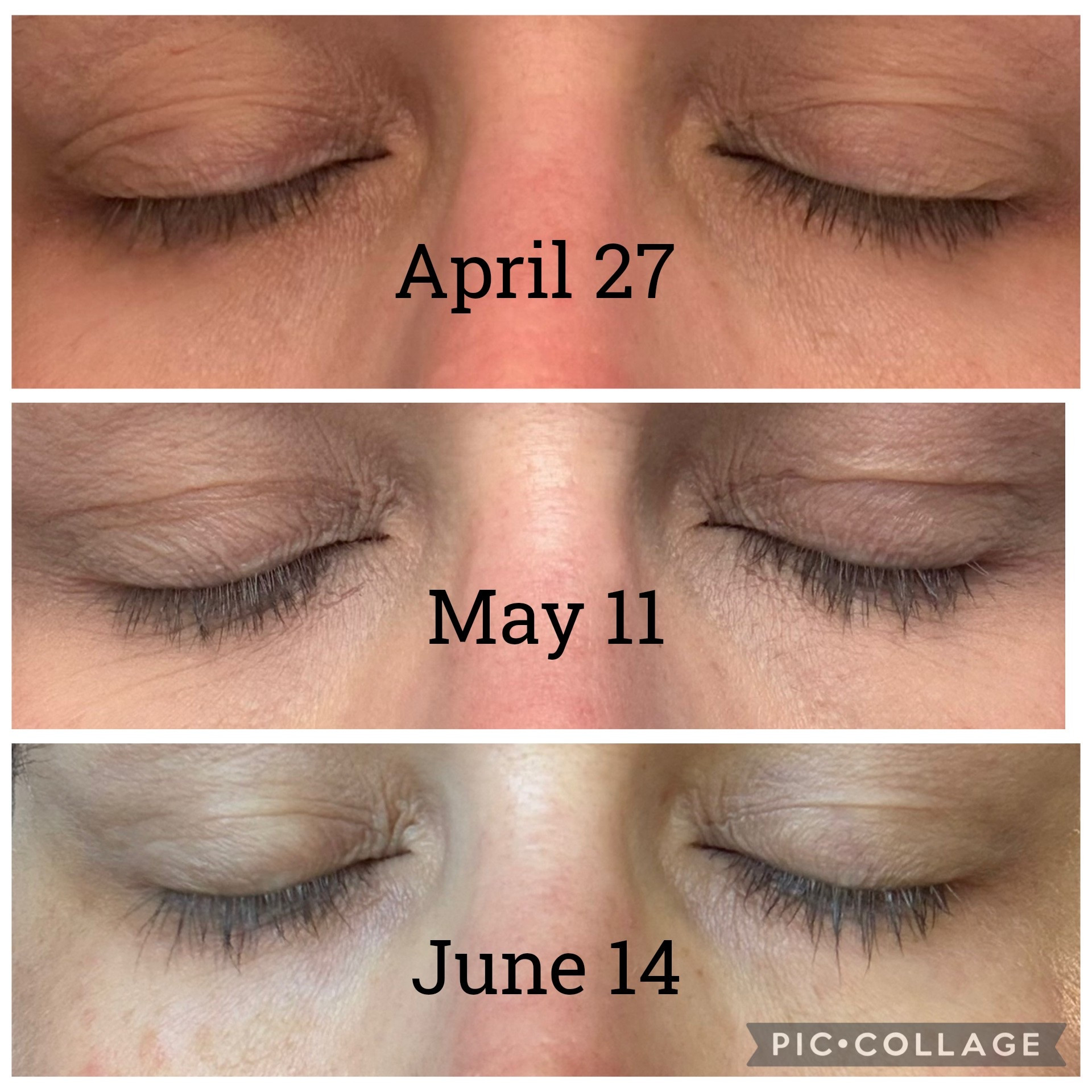 My Eye Area Before & After (7 Weeks)

I’ve been consistently using these two products since late April and wanted to share my progress photos.

The lash growth is obvious to me, especially with mascara, but I’m also really happy with how hydrated and smooth my under-eye area looks compared to where I started.

*Lighting is different. 1st photo at night because I was excited about getting the lash serum sample! 2nd pic mid afternoon. 3rd pic morning. Both products are linked below. I may earn commission from purchases. Both products were gifted to me.

#LTKBeauty #LTKOver40 #LTKselfcare