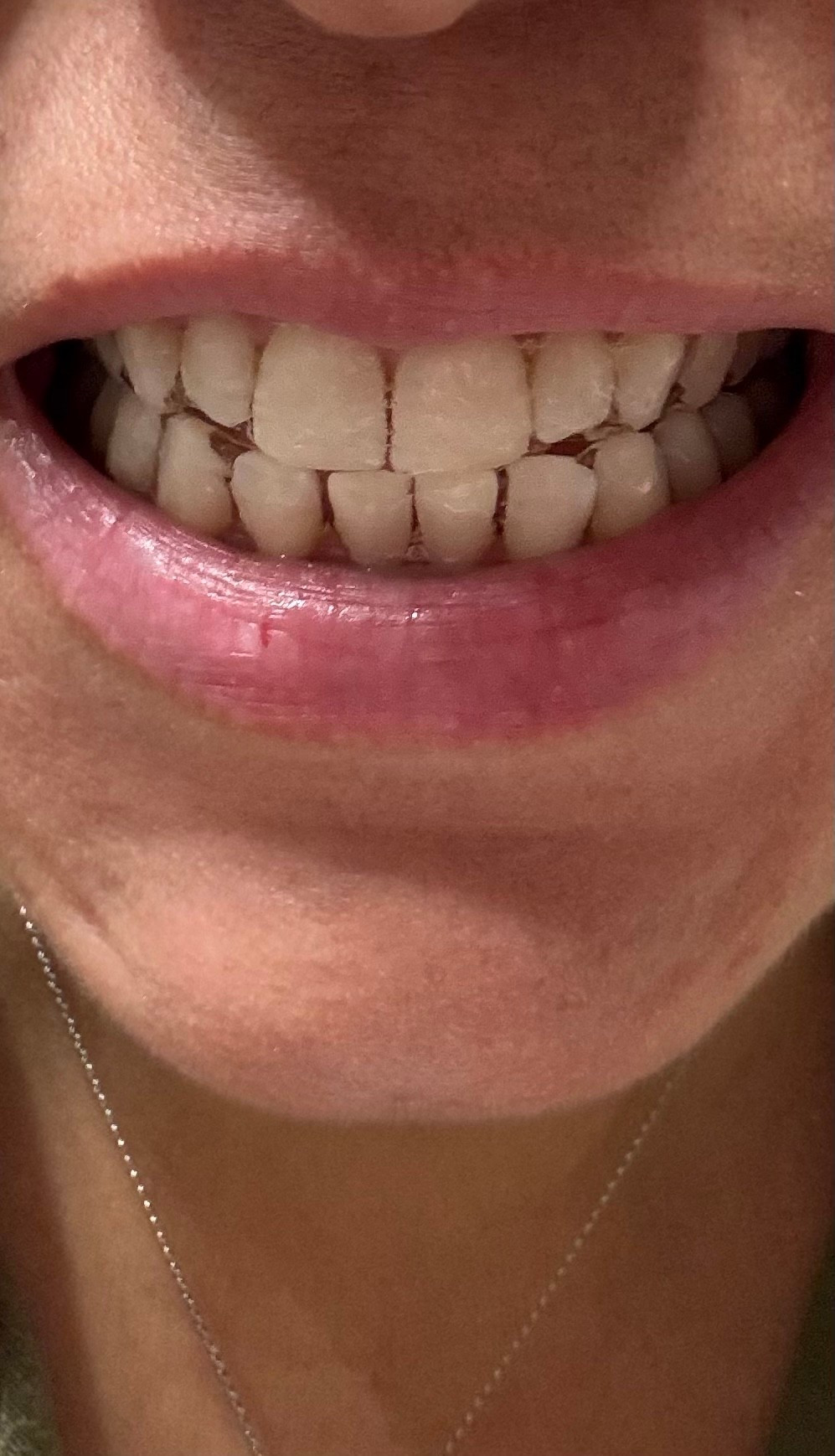 Teeth whitening strips that work !

#LTKselfcare #LTKOver40