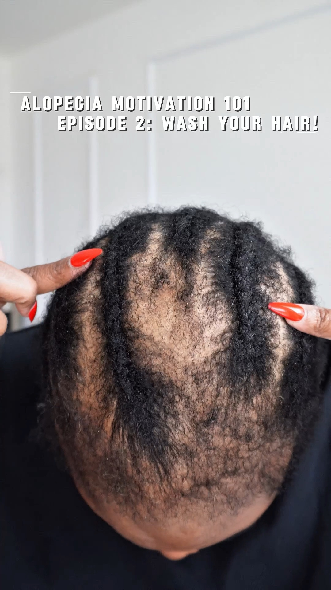 Alopecia Motivation 101
Episode 2: Wash Your Hair! 

#LTKFindsUnder50 #LTKBeauty #LTKFindsUnder100