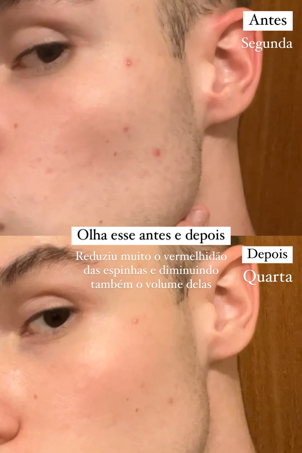 O produto que usei para ter esse resultado é o Sérum Antiacne da Sallve que é simplesmente maravilhoso!! Já estou no 3º tubo indo pro quarto sksk 😅

#LTKbrasil #LTKbeauty #LTKGiftGuide