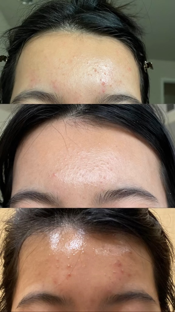 Skincare products that actually helped me get rid of fungal acne and whiteheads aka closed comedones! Results speak for itself ☺️

#LTKselfcare #LTKBeauty