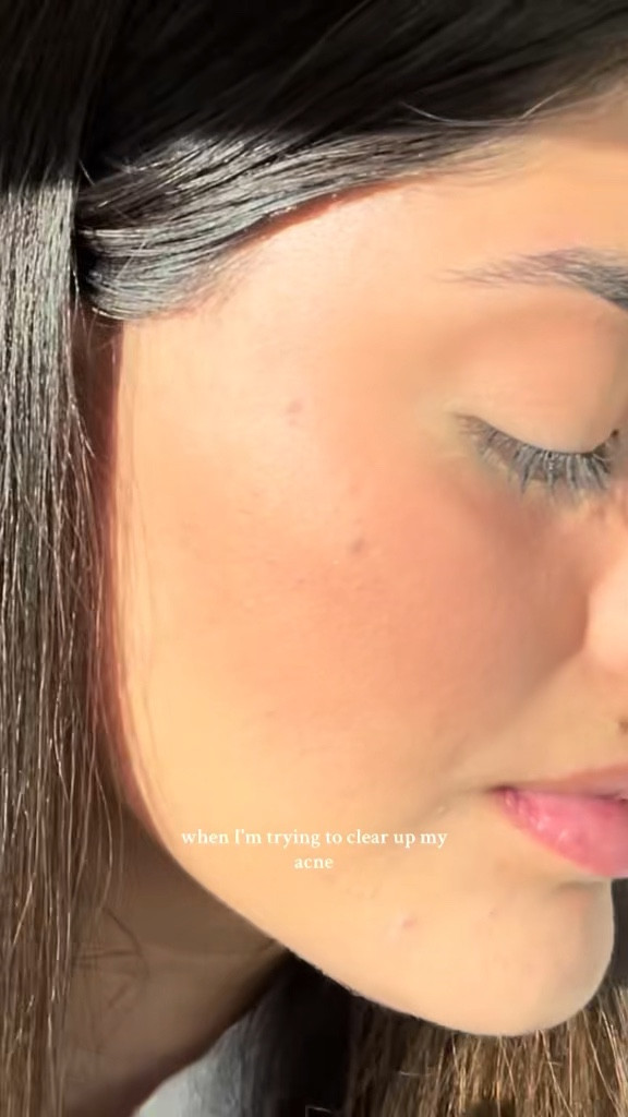 Makeup routine when my skin is breaking out

#LTKBeauty