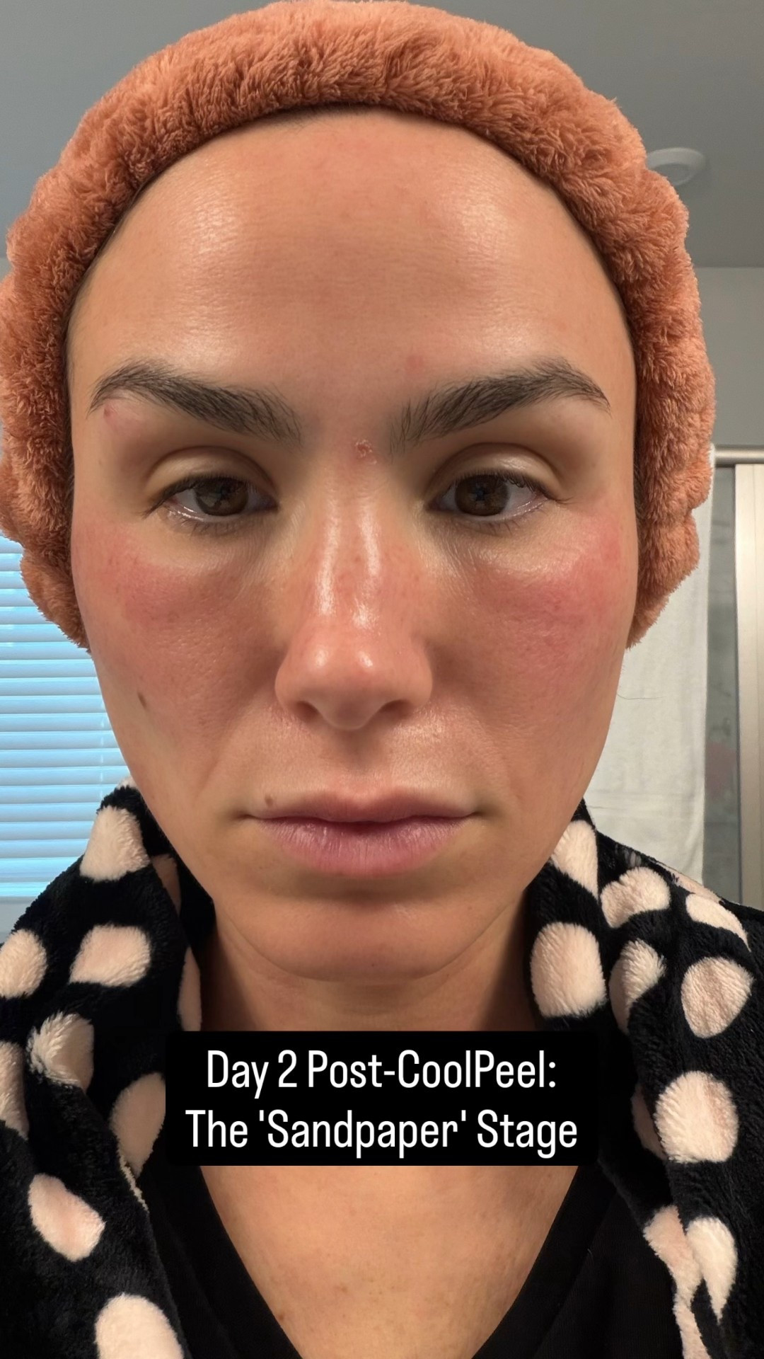 "You drive me crazy... I just can't sleep!" 🎶 ...mostly because I’m obsessed with this post-laser glow-up. ⚡️✨
Welcome to Day 2 of my CO2 CoolPeel recovery! Current status: feeling a little pink, a little swollen, and my skin feels exactly like fine-grit sandpaper when I wash it. (But honestly? That’s just the old skin getting ready to exit the building! 👋🚪)
I’m being extremely picky about what goes on my face right now. Here is the 'Day 2' recovery lineup that is saving my life:
🧼 Cleanse: ZO Skin Health Gentle Cleanser (keeping it simple and soothing).
🧪 Repair: 111SKIN Repair Serum NAC Y2. This stuff is literal liquid gold for healing.
👁️ Eyes: Dr. Diamond’s Metacine Emulsion from the Insta-Facial collection. Keeping the windows to the soul hydrated!
🧖‍♀️ The Star: Finished with the CO2Lift Pro Carboxy Gel Treatment mask to flood my skin with oxygen and moisture.
Feeling 10/10 and absolutely loving the process. The "sandpaper" phase is just a pit stop on the way to Glass Skin City! 📍✨

#LTKselfcare #LTKBeauty #LTKdayinmylife