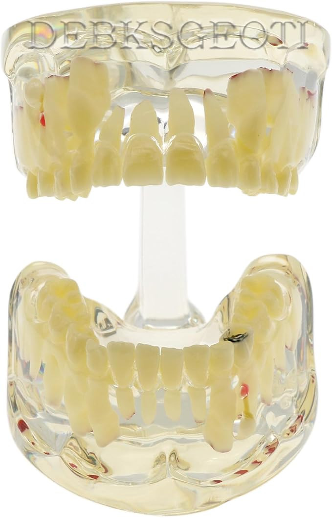 Dental Kids Typodont Pediatric Model Teeth with Caries, Cyst, and Firstula, It Demonstrates The D... | Amazon (US)