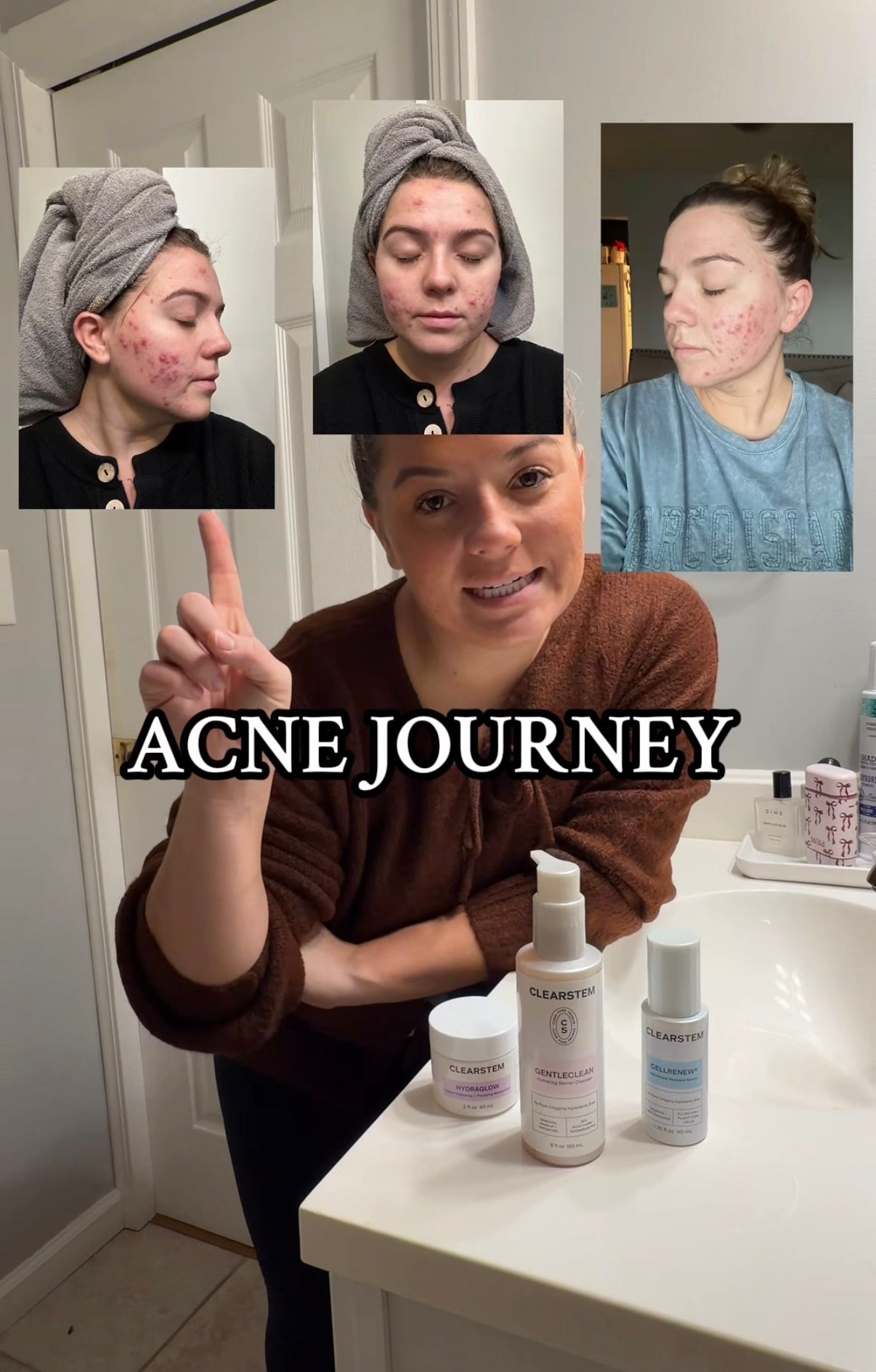 Things that have helped me get my acne under control ⬇️

#LTKmorningroutine #LTKselfcare #LTKFindsUnder100