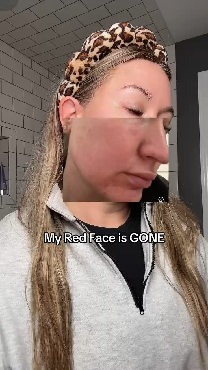 Big mistake ignoring this if redness and acne keep coming back, you need this #skincareroutine #ad 

https://www.tiktok.com/@holistic.wellness.glow/video/7610276021971045645?is_from_webapp=1&sender_device=pc&web_id=7595868255789630984 

 