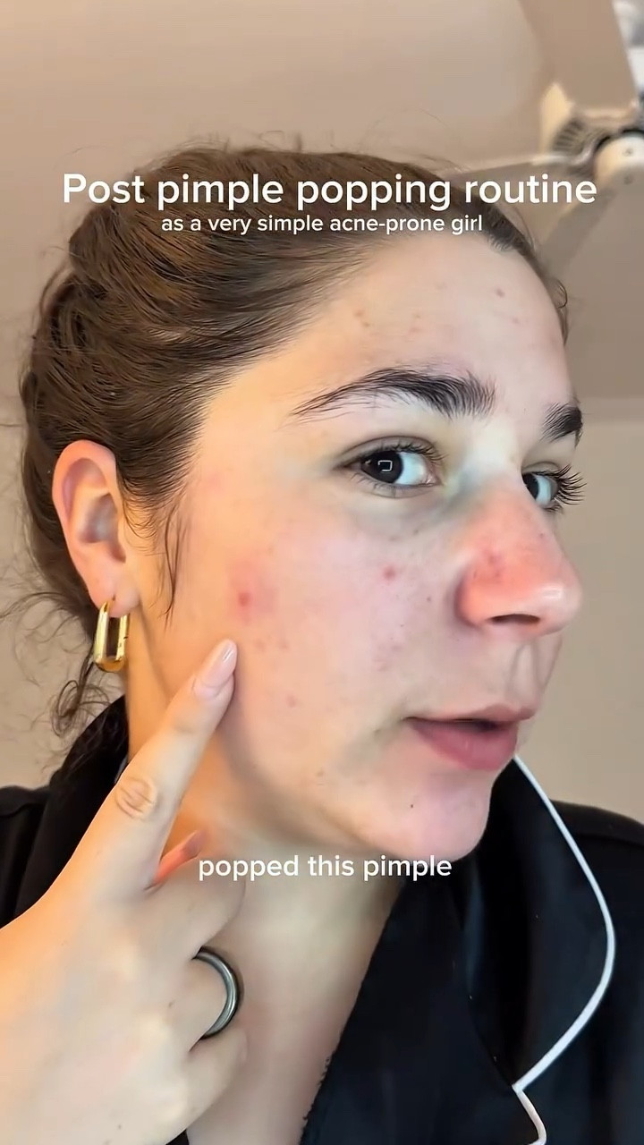Please tell me you used to have those iconic squishies too 👀

@larocheposayusa @idenel_official 

#acnejourney #acneproneskin #pimplepopping #acneroutine #pimplepopper

#LTKgrwm #LTKBeauty #LTKselfcare