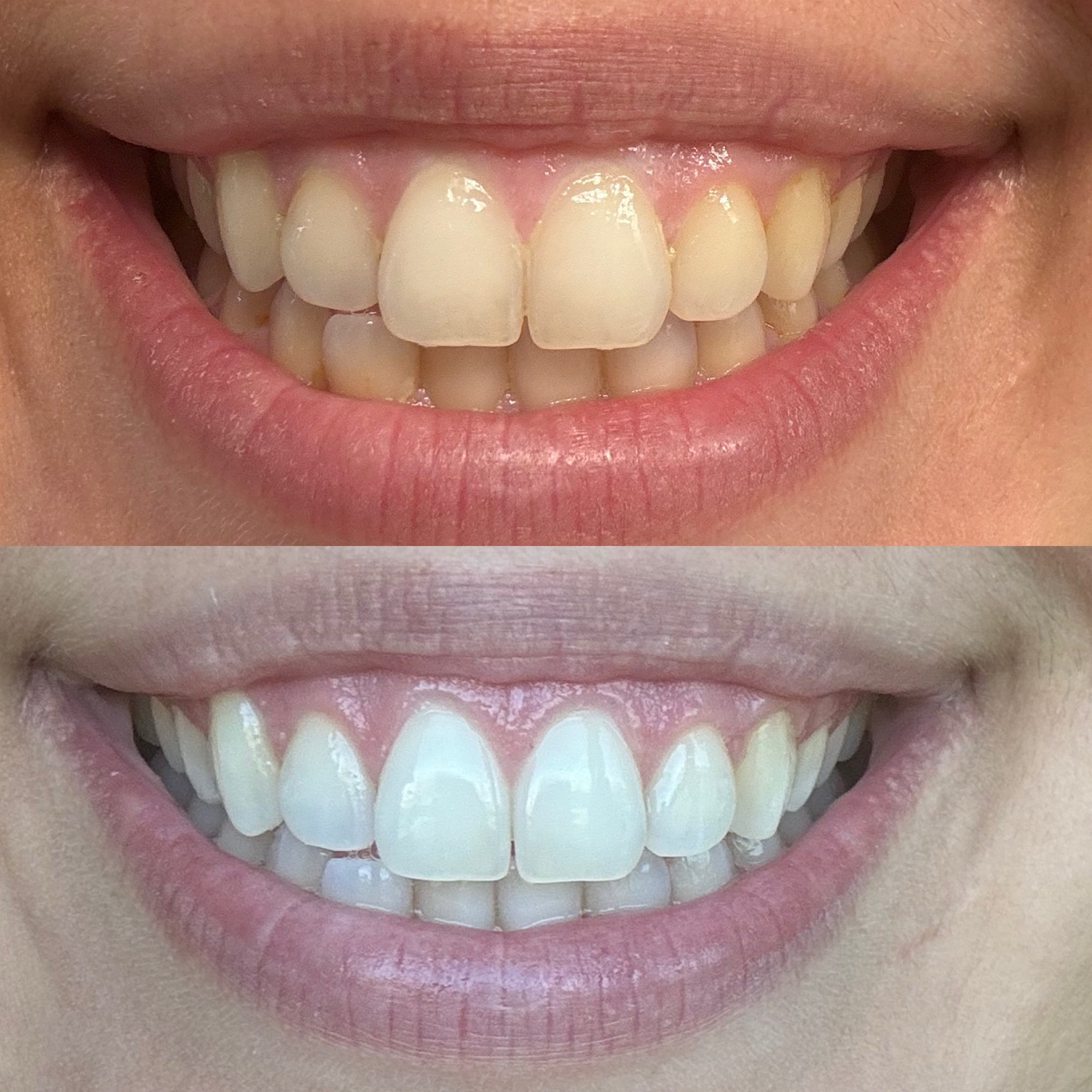 WHITE STRIPS! Clean(ish) ingredients 🙌🏼

#LTKU #LTKBeauty #LTKWedding