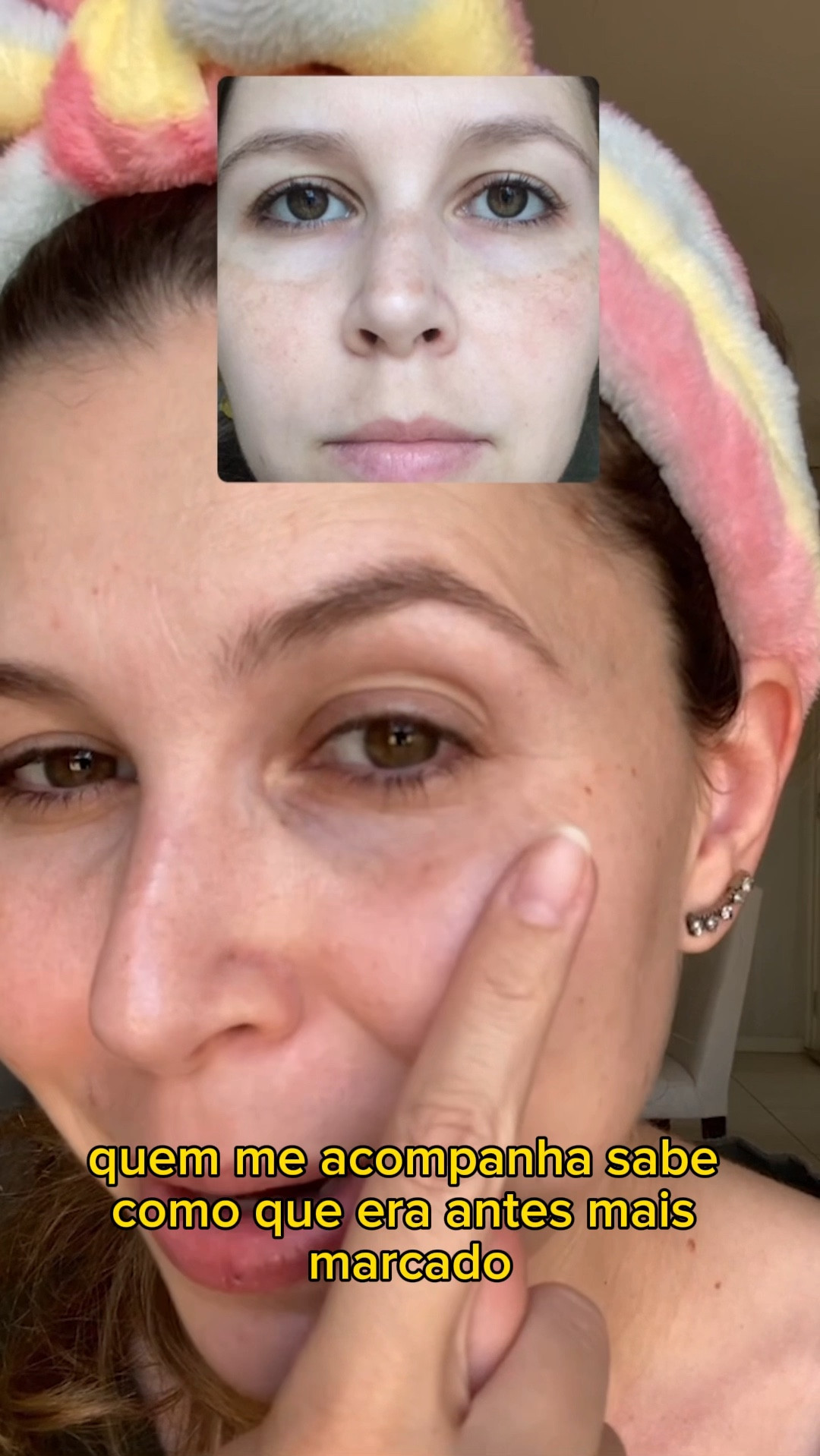 O creme facial Eucerin Anti Pigment Dia FPS 30 tem feito parte da minha rotina matinal já faz 2 anos! Ele ajuda a controlar a hiperpigmentação da pele, reduzindo minhas manchinhas de melasma. 

É importante saber que além dele, faço uso de outros produtos e medicamentos indicados pela minha dermatologista para tratar o melasma e ter melhores resultados (como viram na foto que mostrei no vídeo). 

O creme facial Eucerin não é baratinho, mas vale cada centavo, deixa minha pele hidratada, cuida das minhas manchinhas e ainda rende muiiiito! Uso ele todos os dias, e 1 frasco demora em torno de 1 ano para acabar! Bom d+, né? 

#LTKBrazil #eucerin #melasma #cremeparaclarearmanchas #cremeparamelasma

#LTKbeauty #LTKbrasil