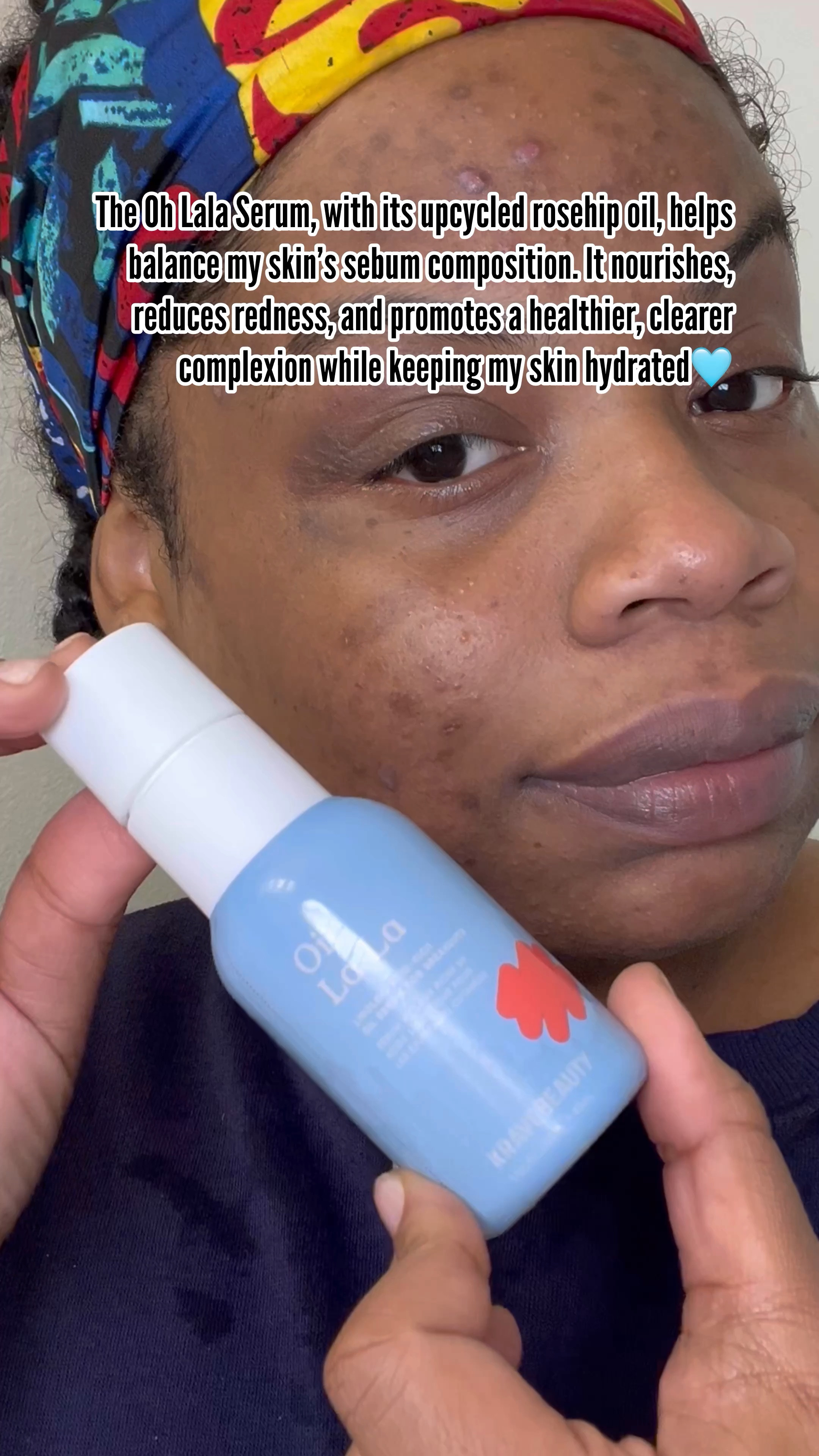 If you’re battling breakouts, it’s time to add some balance back into your skincare routine. The Oil La La Serum is packed with linoleic acid-rich oils to support clear, hydrated skin without clogging pores. Say goodbye to dryness and inflammation while giving your skin the moisture it craves. 🙌 Perfect for anyone with acne-prone skin, this lightweight serum is a total reset for your skin barrier. 💧 #SkincareEssentials #serum #serumsforacne

#LTKGiftGuide #LTKStyleTip #LTKBeauty