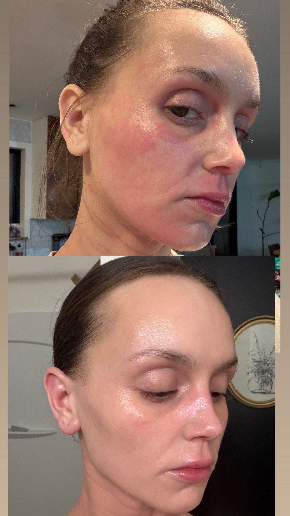 How I got my skin flare back under control, I’ve tested and LOVE these products! 🙏🏼 this was a 4 DAY DIFFERENCE 🤯

#LTKBeauty #LTKdayinmylife #LTKselfcare